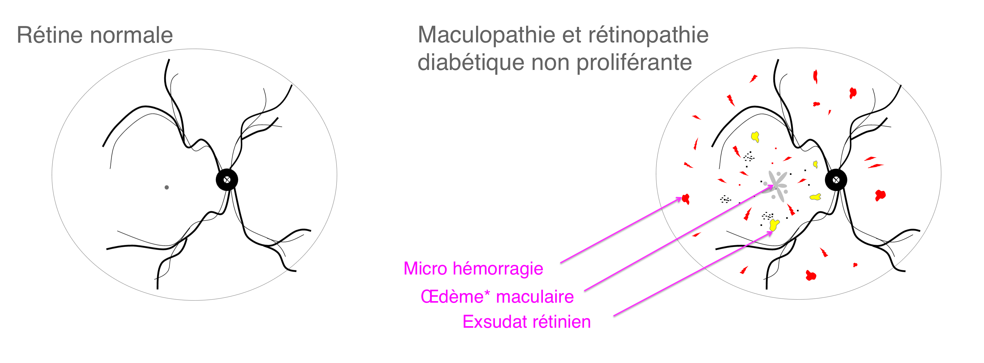 les complications rétiniennes liées au diabète : les signes de rétinopathie et de maculopathie diabétique