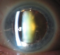 Présence d'une opacifiaction jaunâtre du cristallin ou cataracte