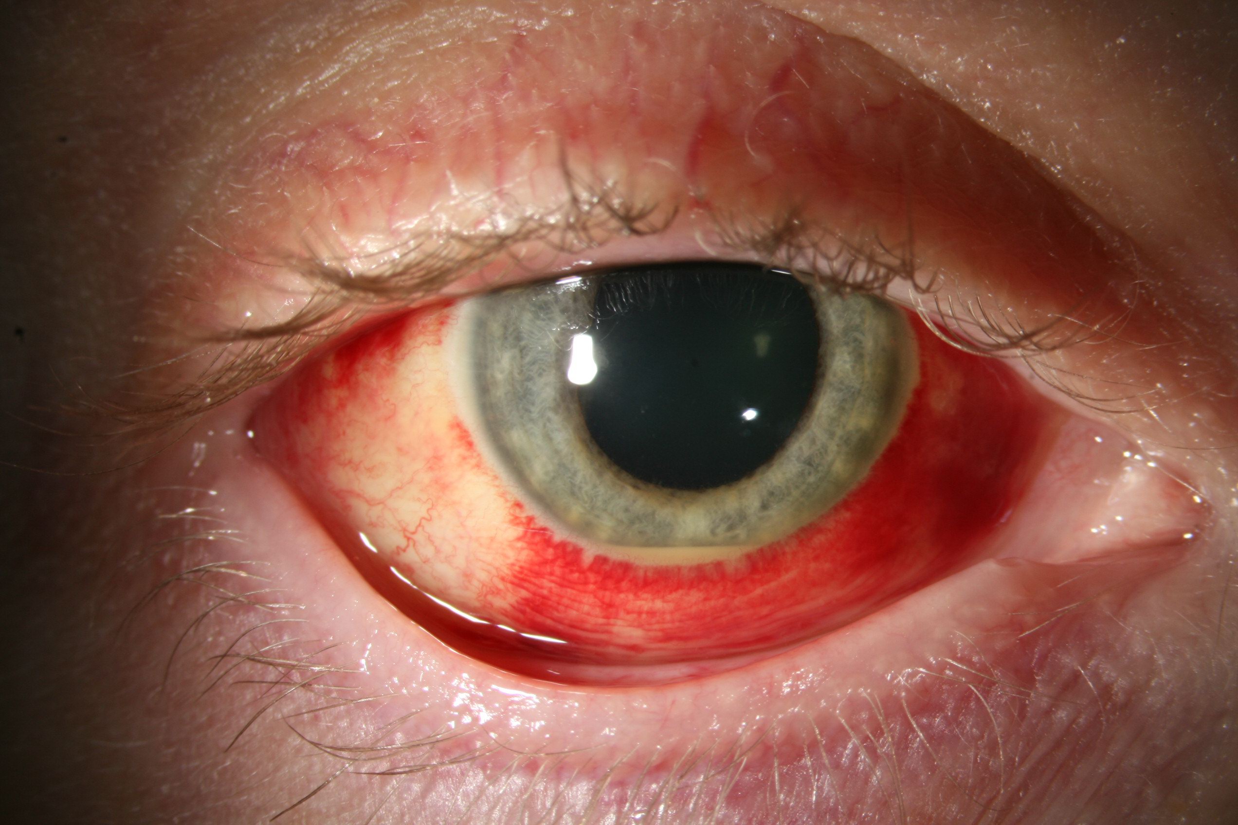 Pathologies Oculaires L Hemorragie Sous Conjonctivale Pole Vision Val D Ouest Centre Specialiste De L Ophtalmologie A Lyon Pathologies Oculaires L Hemorragie Sous Conjonctivale Pole Vision Val D Ouest Centre Specialiste De L Ophtalmologie A Lyon