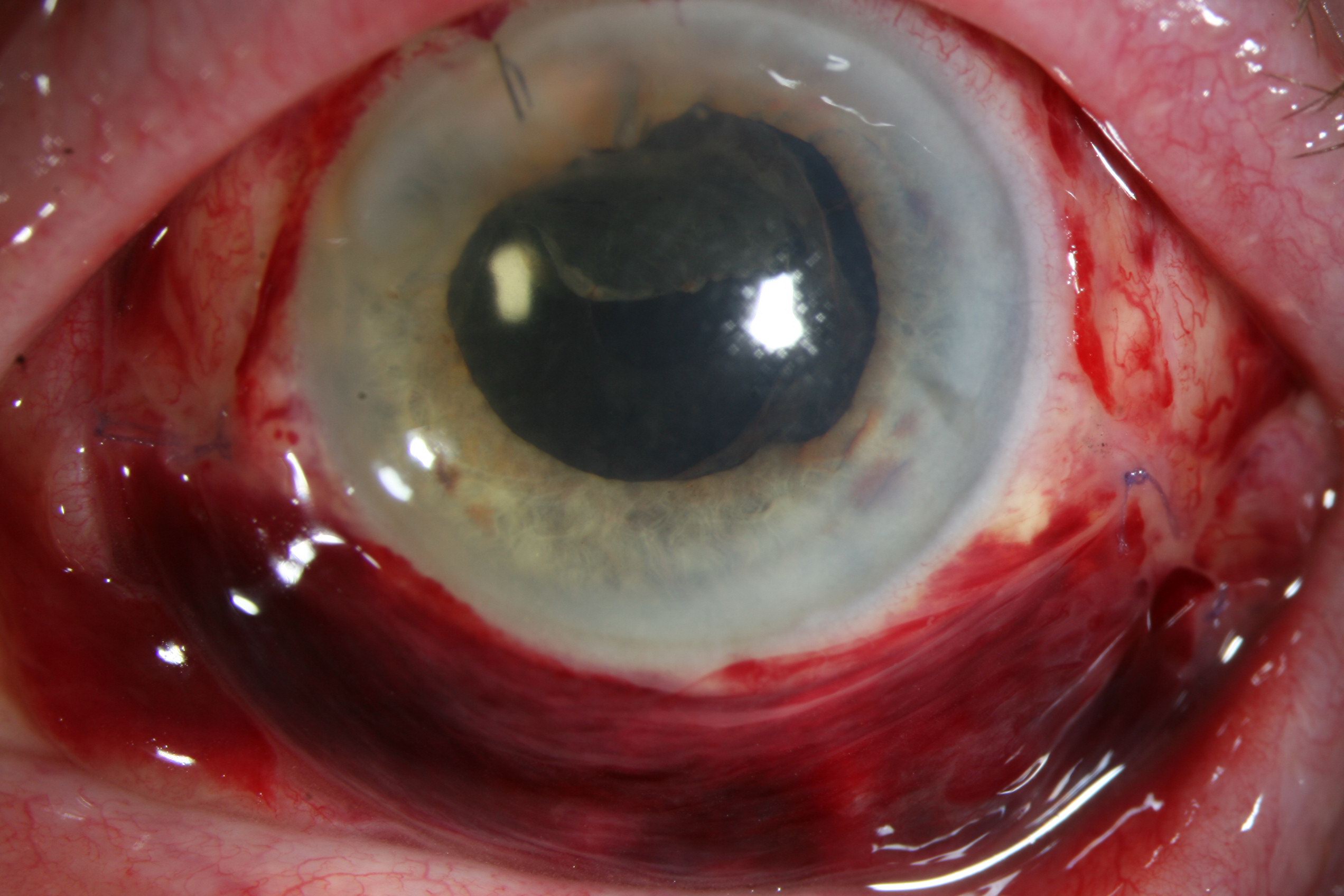 Hémorragie sous conjonctivale secondaire à une opération oculaire