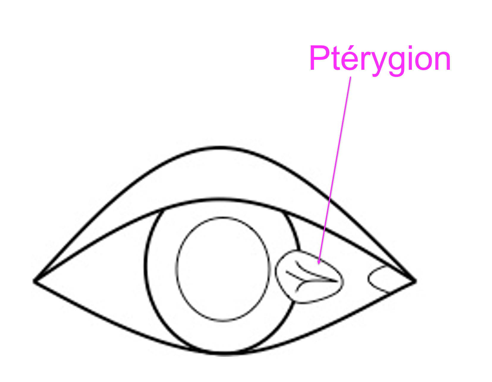 représentation schématique d'un ptérygion à la surface de l'oeil