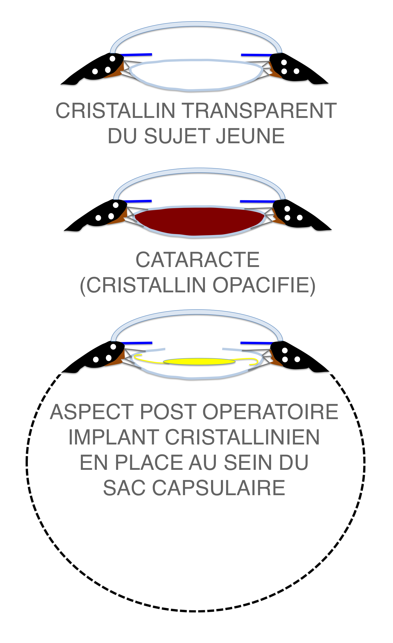 le cristallin atteint par la cataracte (en haut) est remplacé par un implant (en bas)