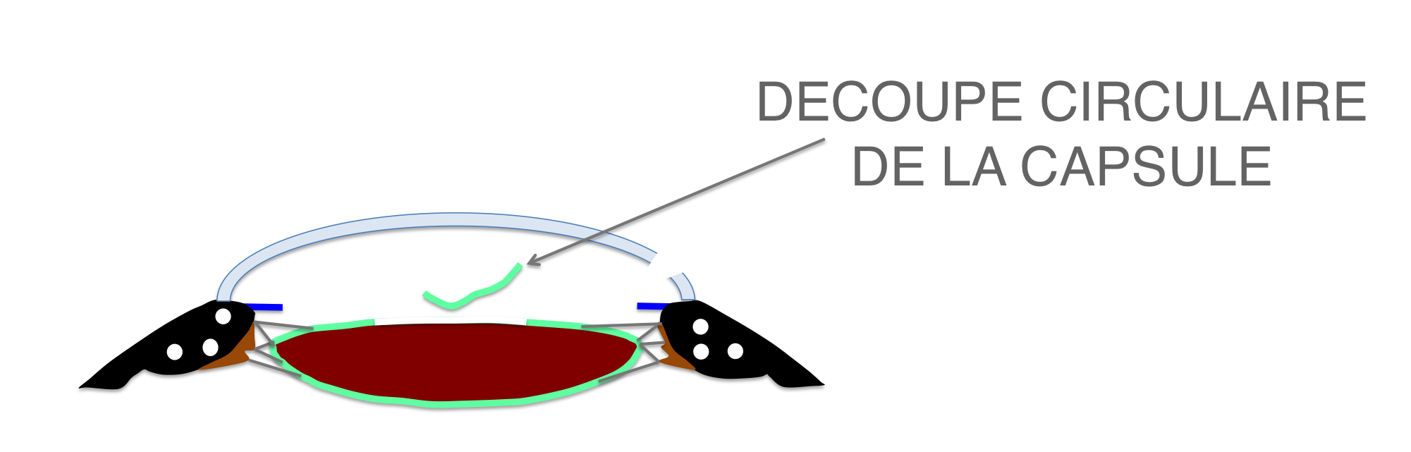 une découpe circulaire (ou capsulorhexis) est réalisée au niveau de la capsule antérieure du cristallin lors de la chirurgie de cataracte