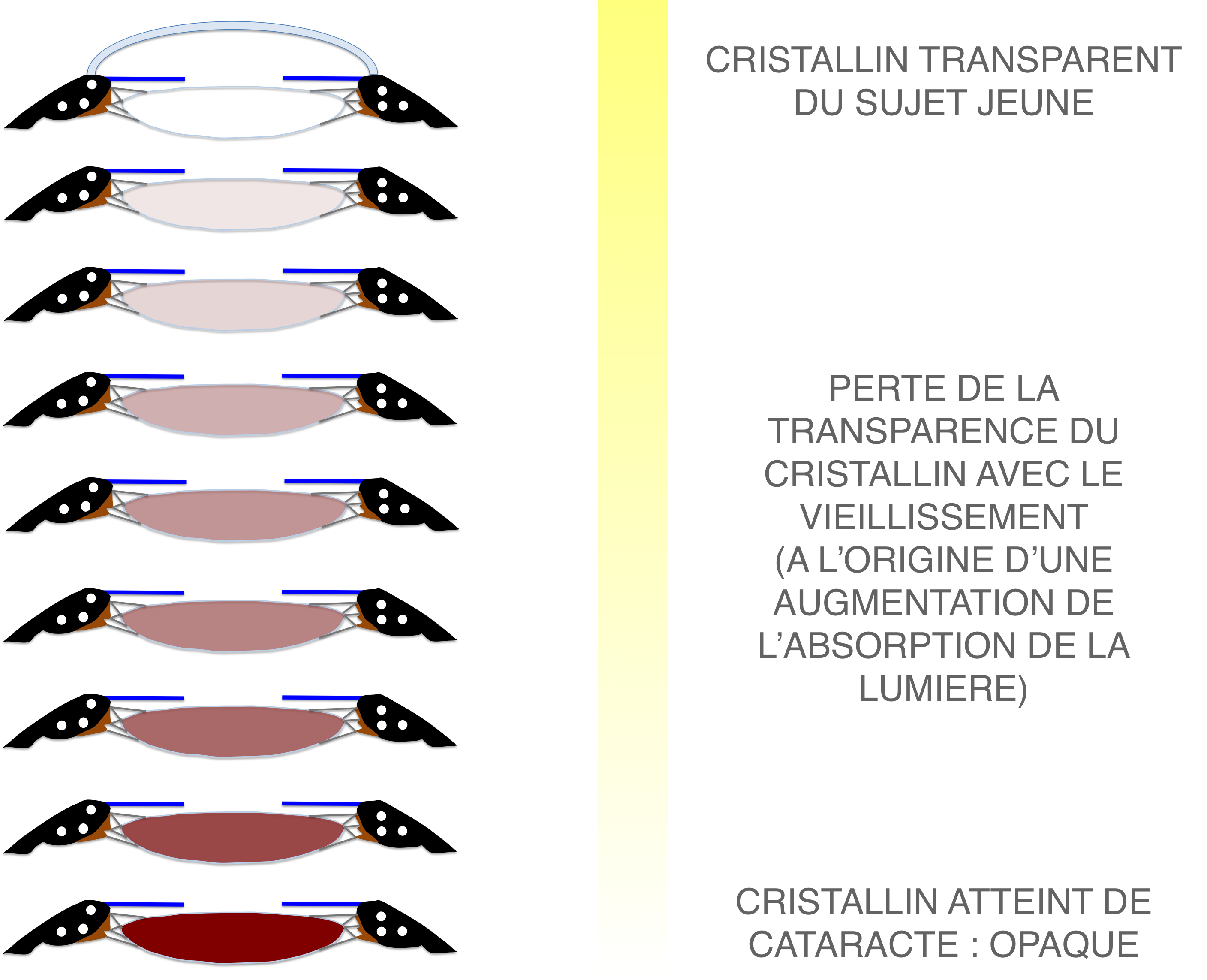 opacifiaction du cristallin au cours du vieillissement à l'origine de la cataracte