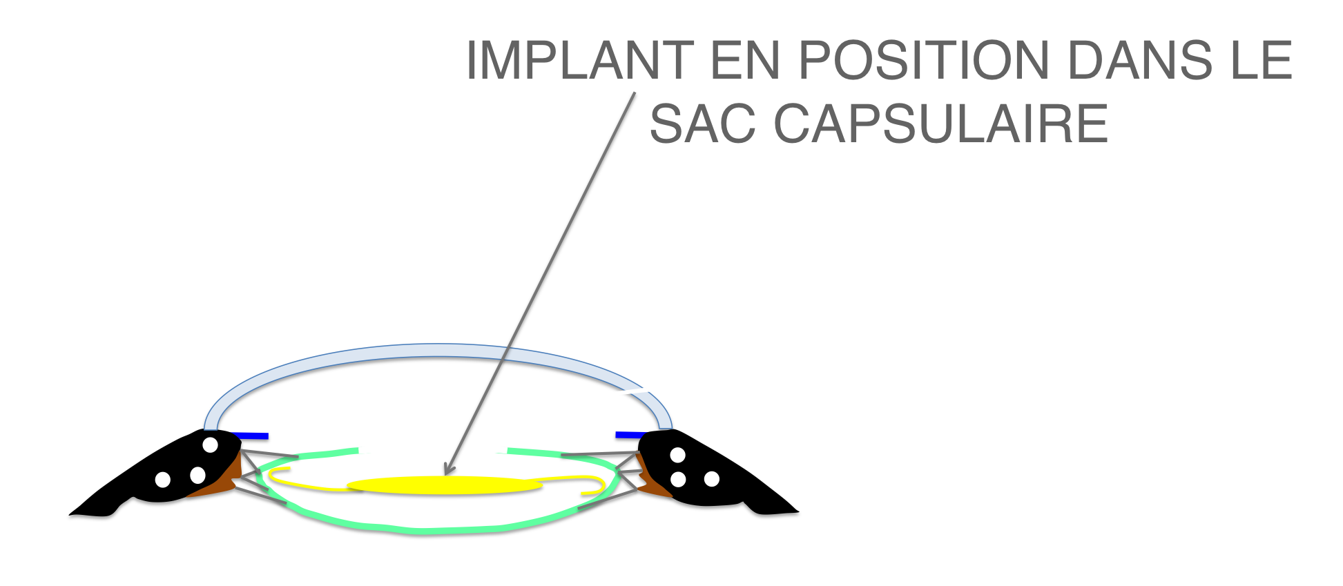 implant ou lentille intra oculaire en position définitive en fin de chirurgie de cataracte