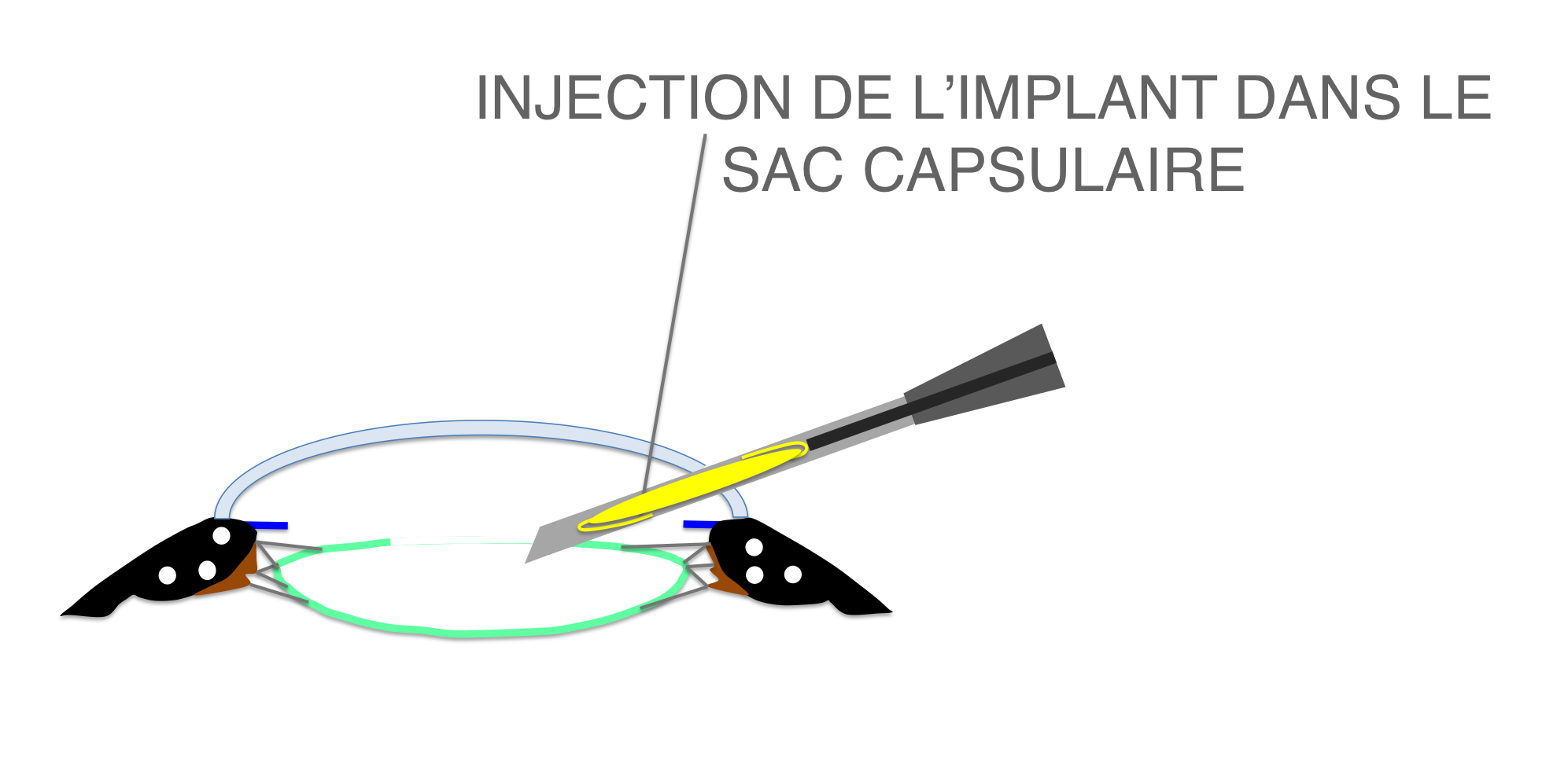 implantation du cristallin artificiel (implant ou lentille intra oculaire) lors de la chirurgie de cataracte