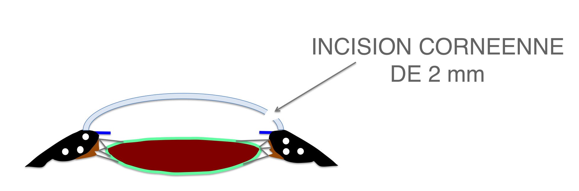 l'intervention de cataracte débute par la réalisation d'une petite incision au niveau de la cornée
