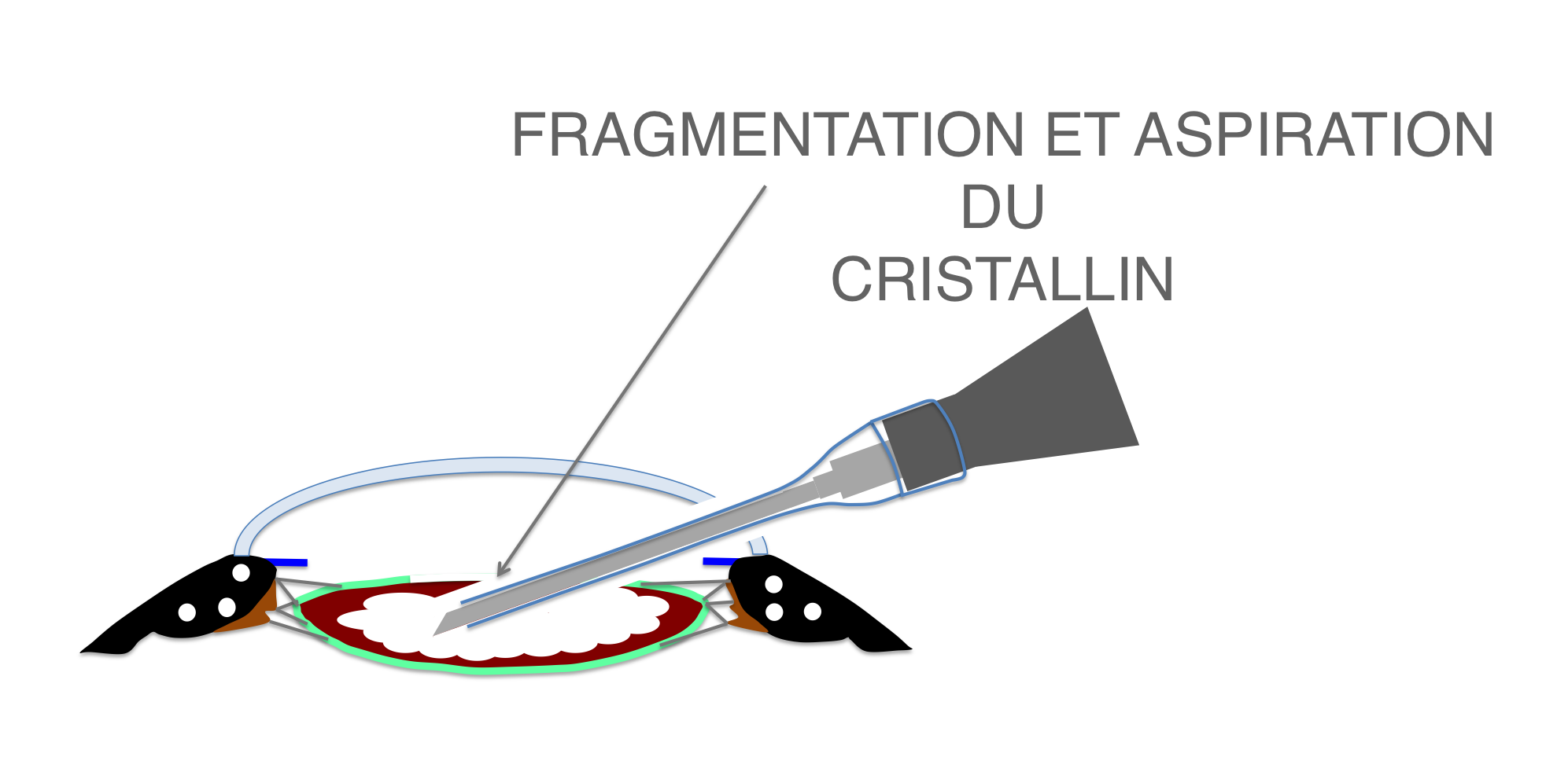 fragmentation par ultrasons et aspiration en voie d'achèvement du cristallin (phakoémulsification) lors de la chirurgie de cataracte