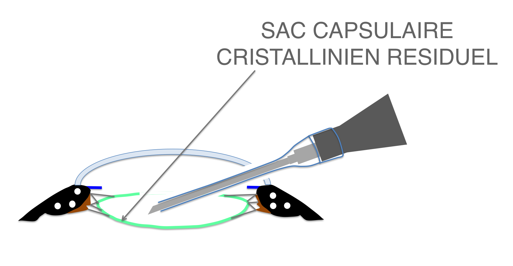 fragmentation par ultrasons et aspiration du cristallin achevées (phakoémulsification) lors de la chirurgie de cataracte