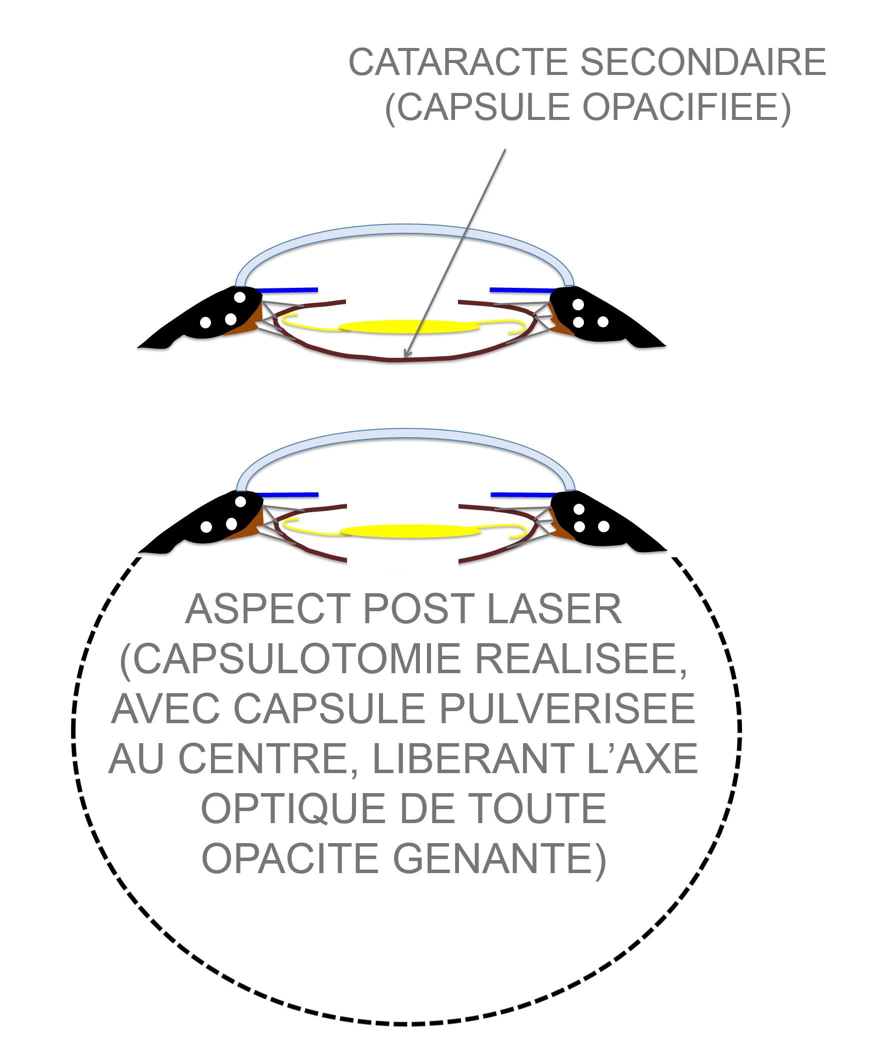 aspect de la capsule postérieure du cristallin avant et après traitement de la cataracte secondaire par pulvérisation de la fibose capsulaire centrale au LASER YAG (capsulotomie LASER)