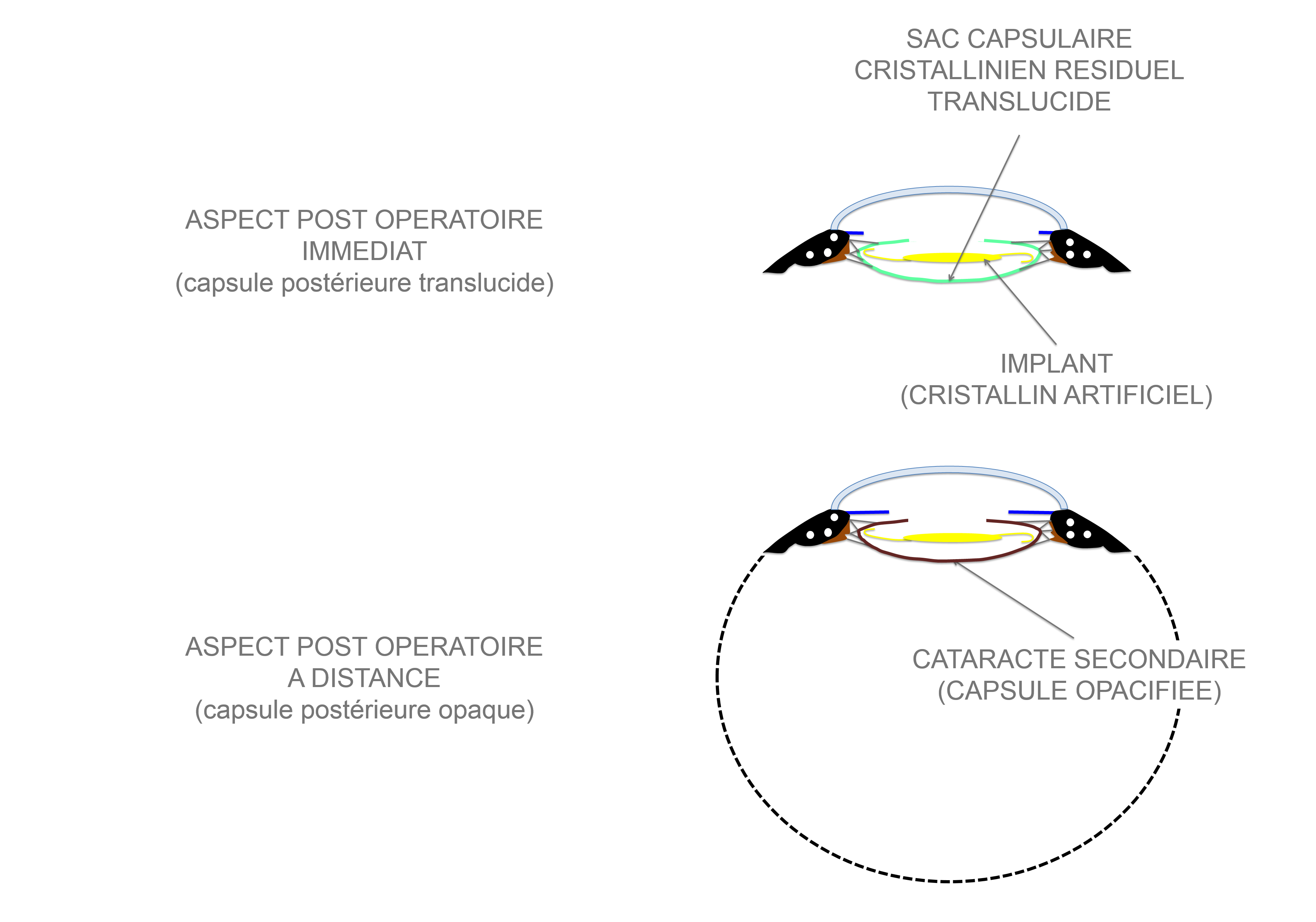 aspect immédiat post chirurgie de cataracte et aspect à distance avec apparition d'une cataracte secondaire