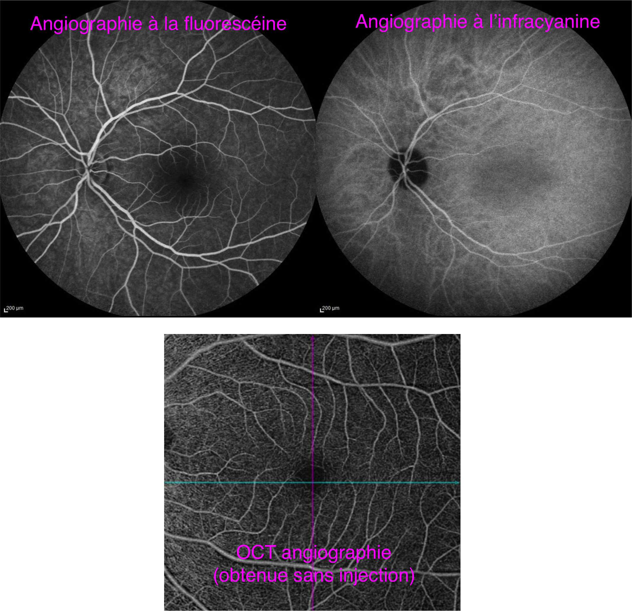 la vascularisation de la rétine objectivée par angiographie conventionnelle (images du haut) et par OCT Angiographie sans injection de colorant (en bas)
