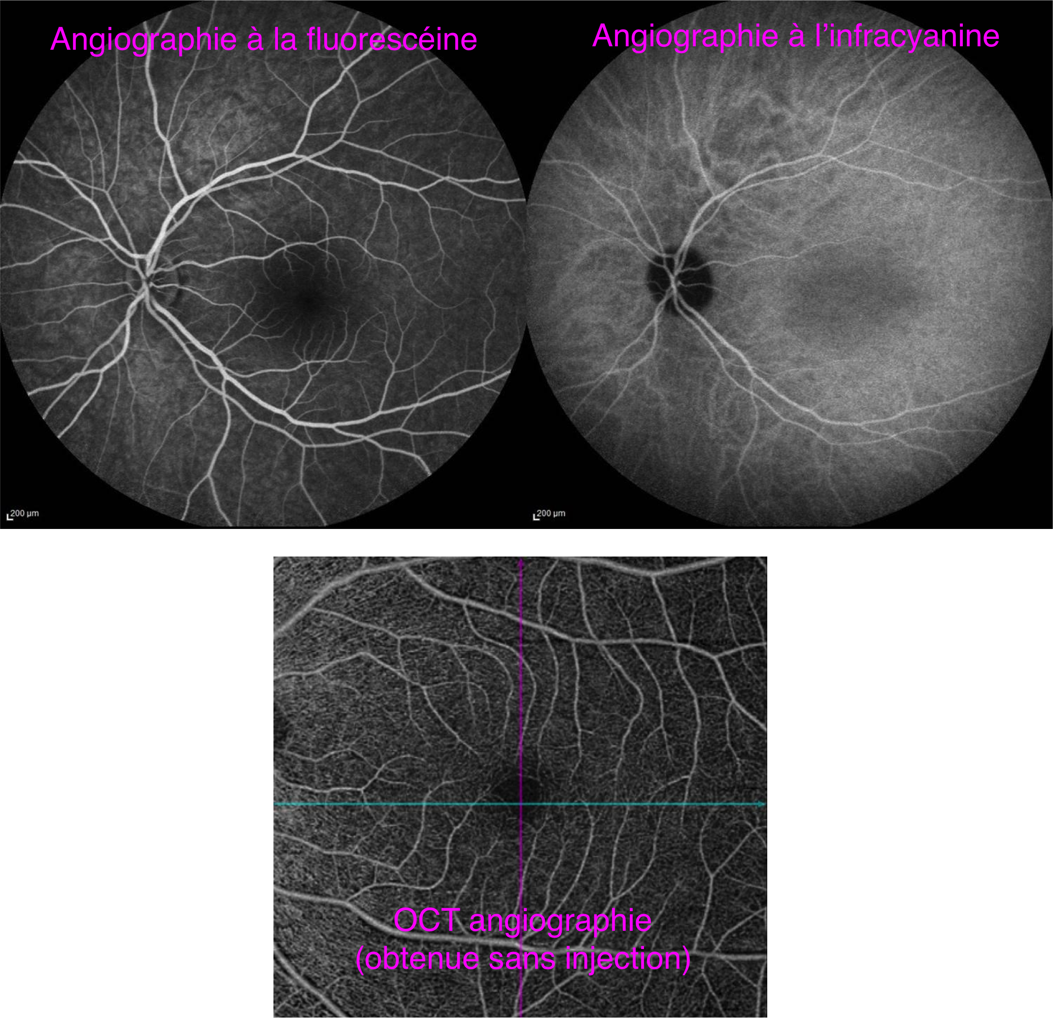 la vascularisation de la rétine étudiée par angiographie