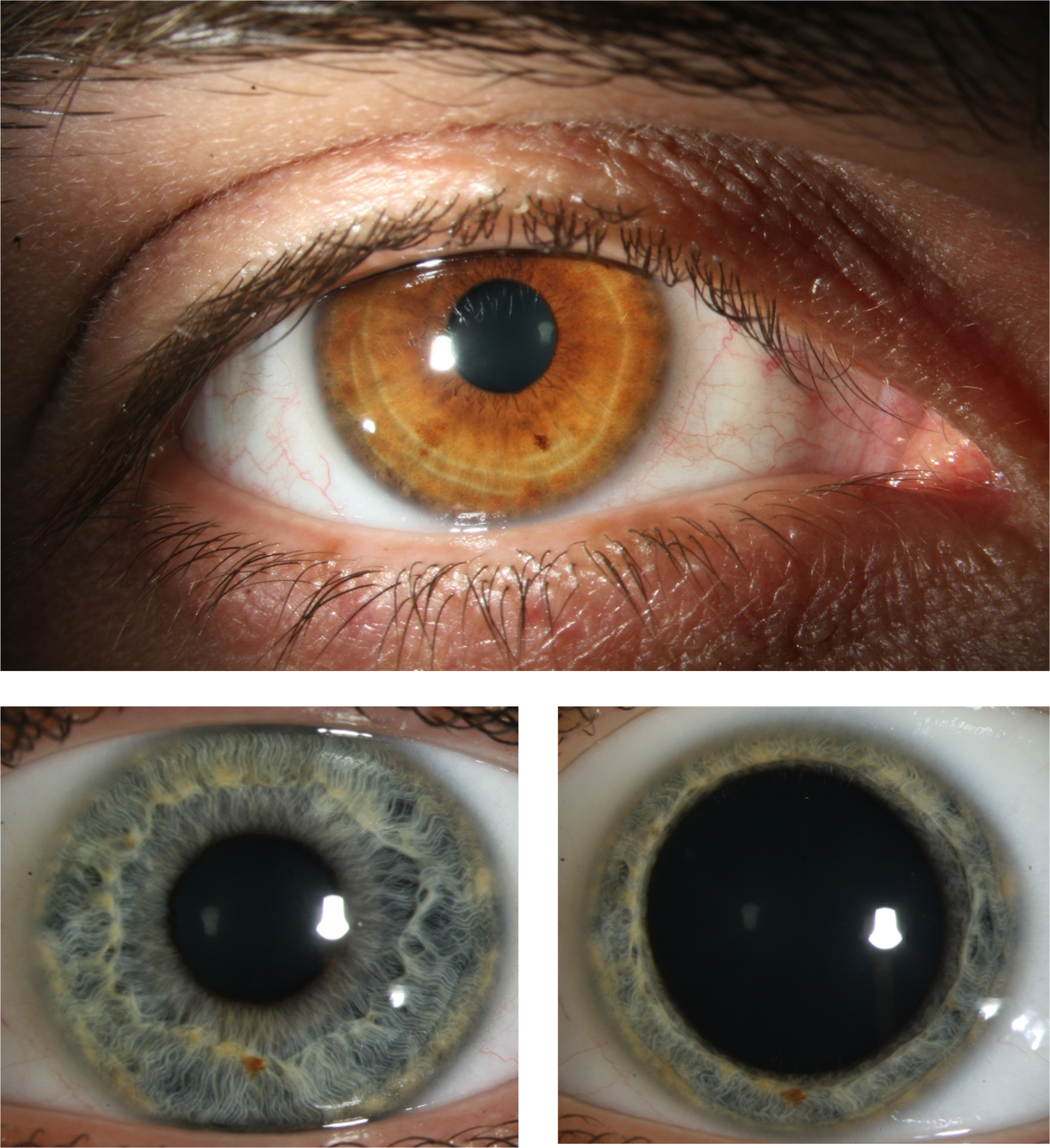 L'iris confère sa couleur à l'oeil et régule le diamètre de la pupille