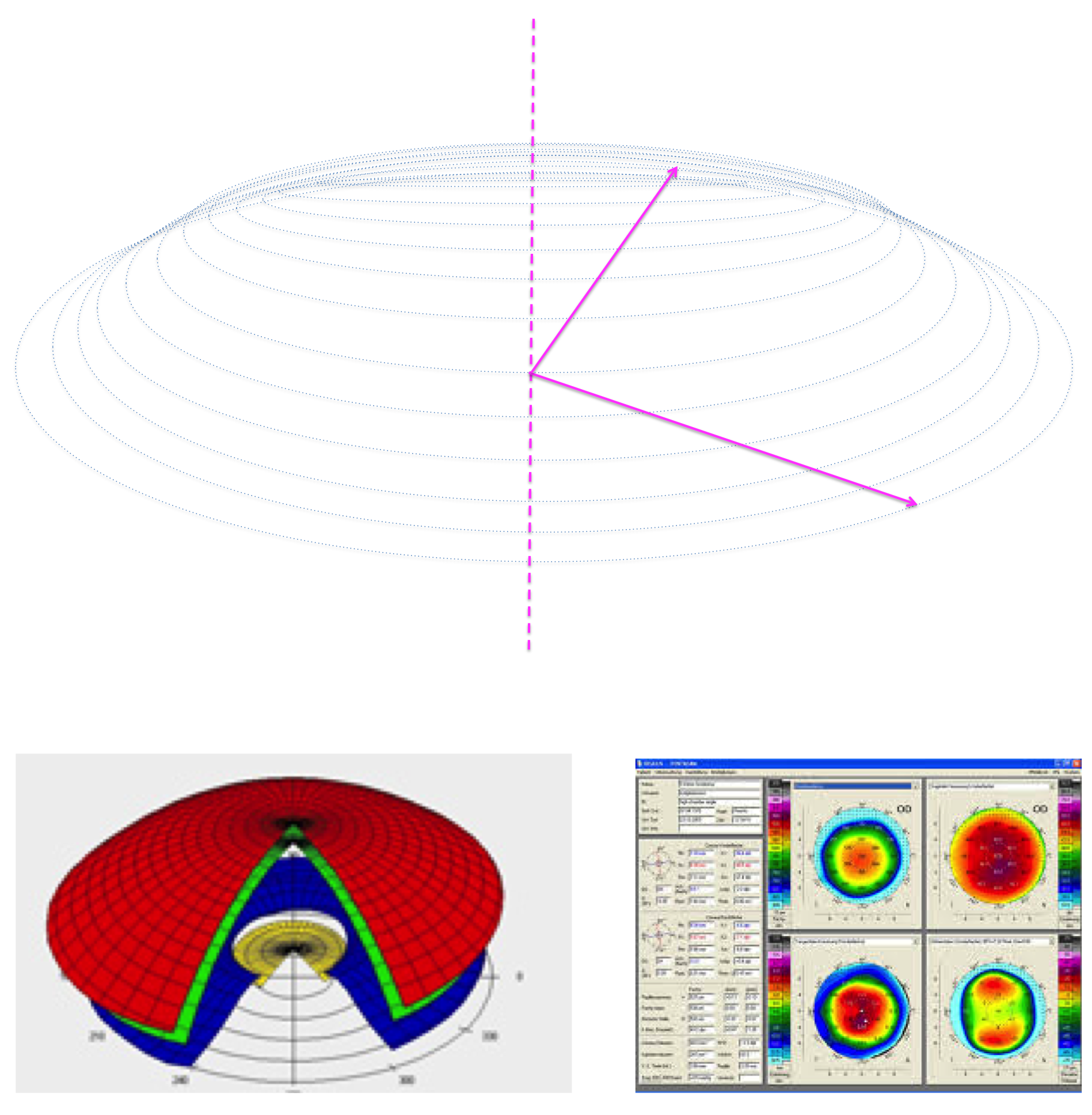 Cartographie des rayons de courbure de la cornée obtenue par topographie cornéenne