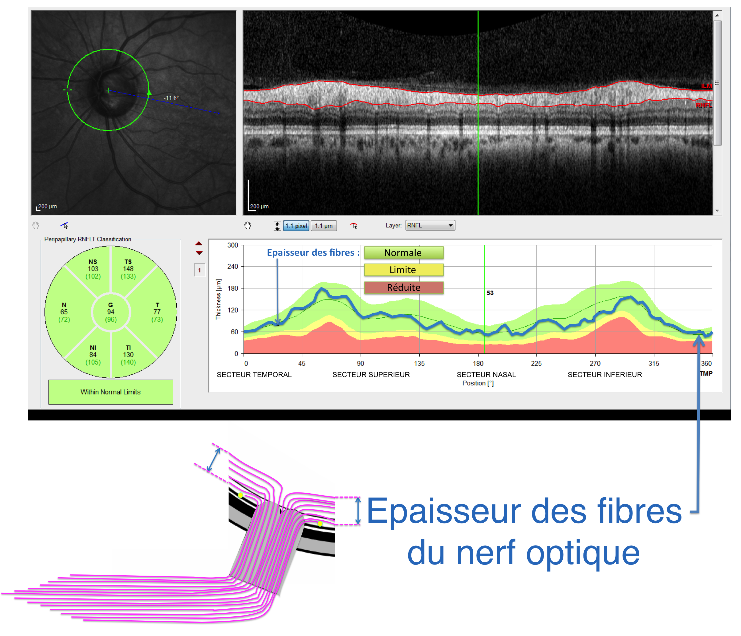 évaluation de l'épaisseur des fibres nerveuses du nerf optique par OCT