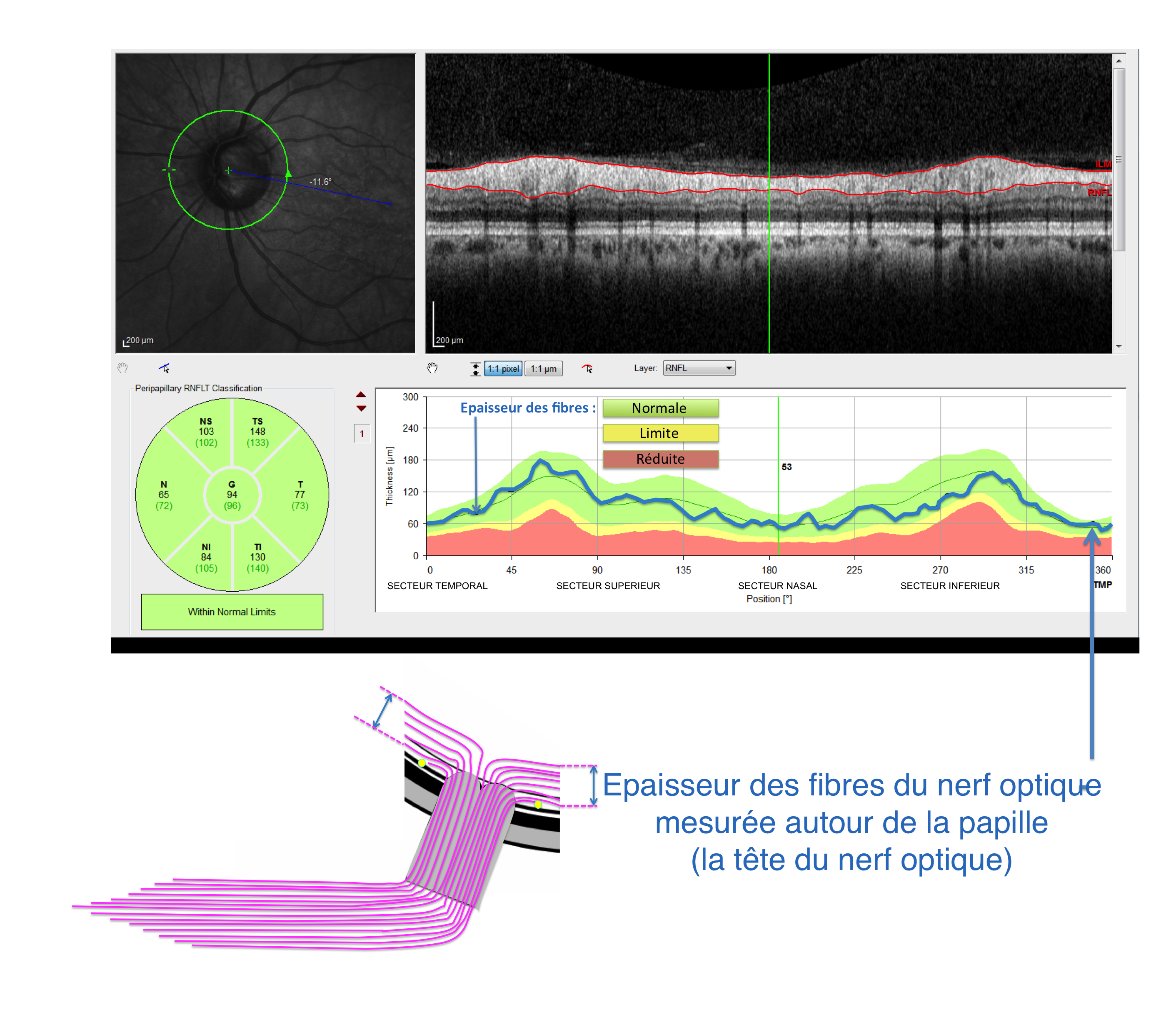hypertonies intra oculaires et glaucomes : analyse en OCT de l'épaisseur des fibres du nerf optique utile au diagnostic et au suivi évolutif