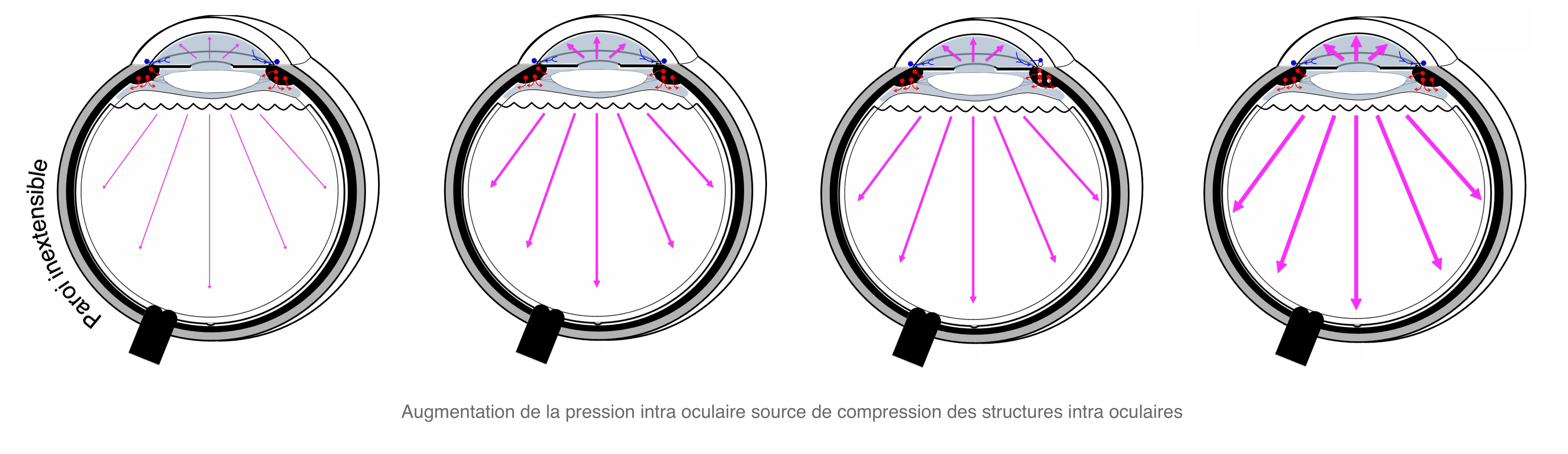 hypertonies intra oculaires et glaucomes : accumulation d'humeur aqueuse au sein du globe oculaire dont la paroi est inextensible source d'hypertonie intra oculaire et de compression des structures intra oculaires