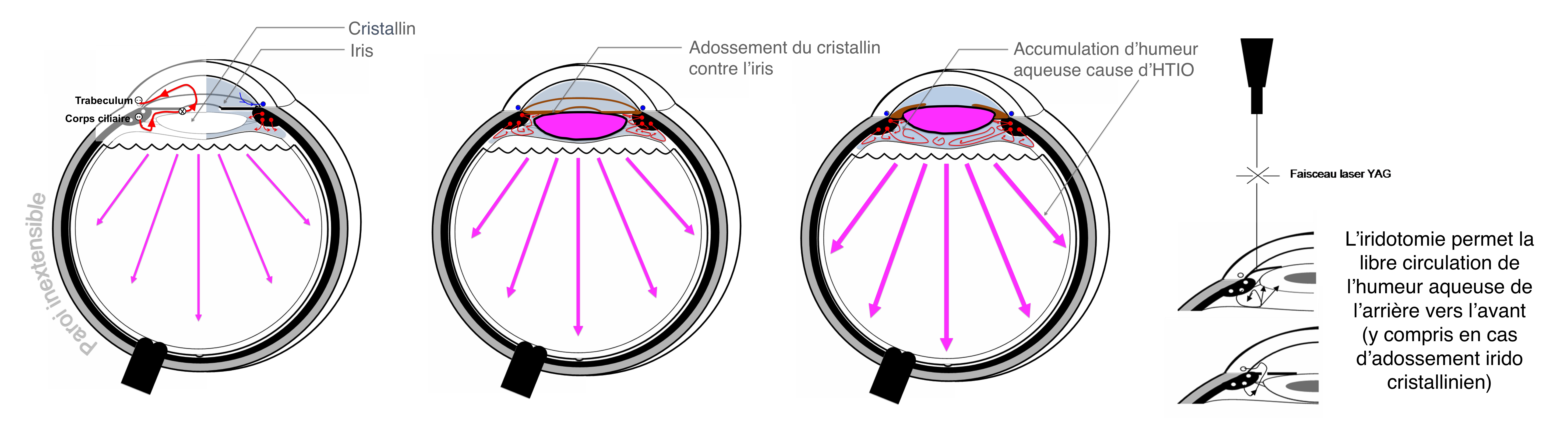 hypertonies intra oculaires et glaucomes : mécanisme physiopathologique et principe du traitement de la crise aiguë d’hypertonie oculaire