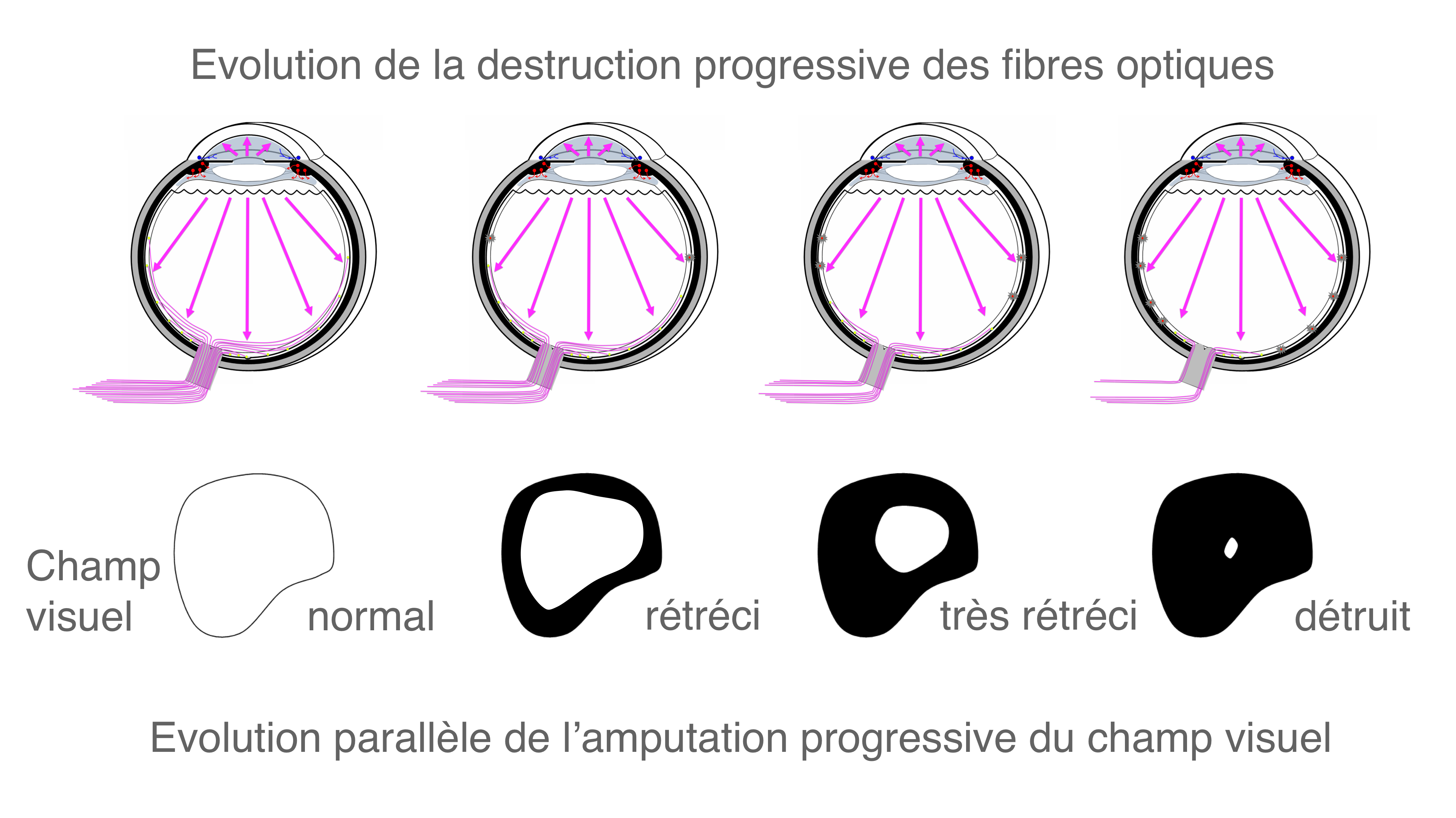 hypertonies intra oculaires et glaucomes : rétrécissement concentrique du champ visuel avec la progression de la neuropathie optique glaucomateuse au fil du temps