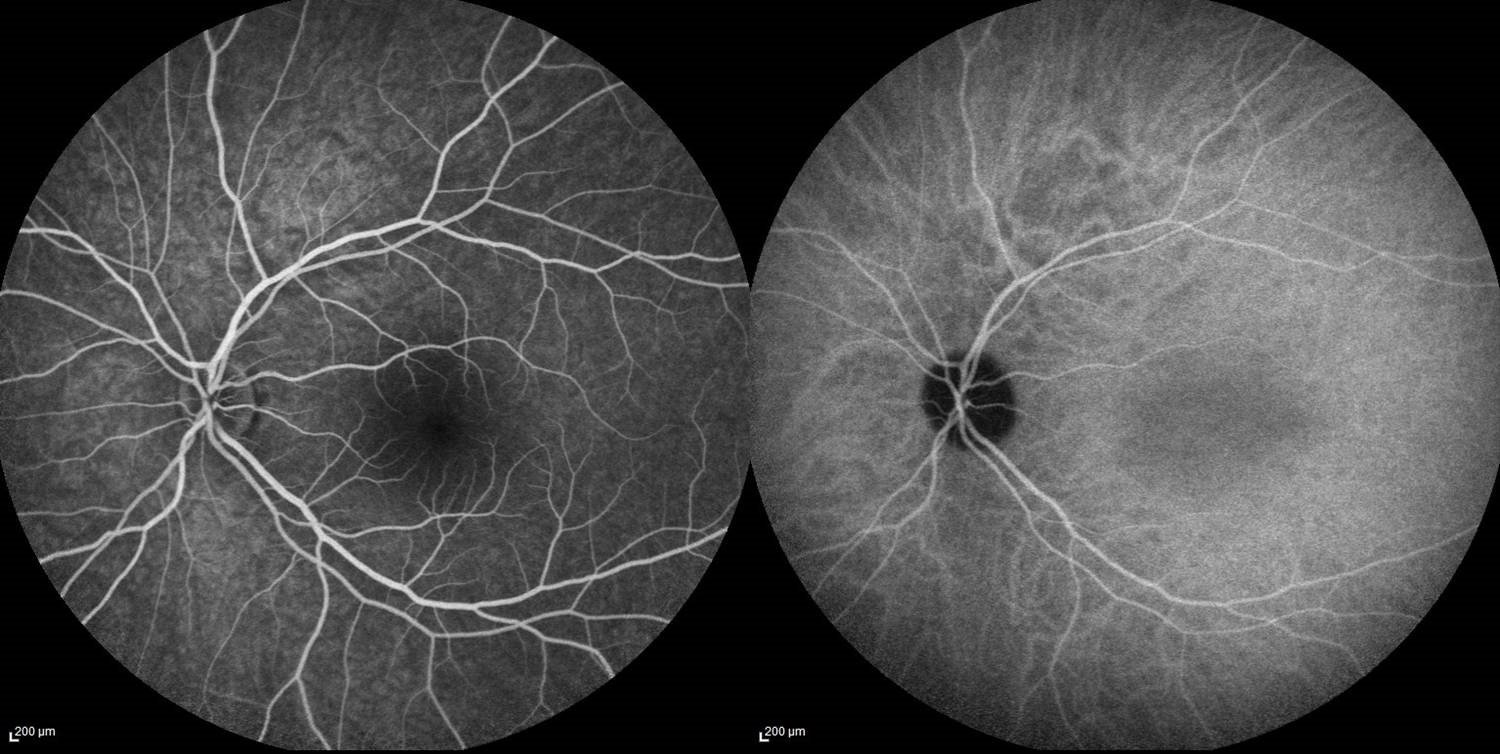 Angiographie à la fluoréscéïne (à gauche) et au vert d'indocyanine (à droite)