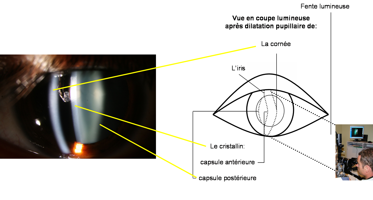 Examen à la lampe à fente