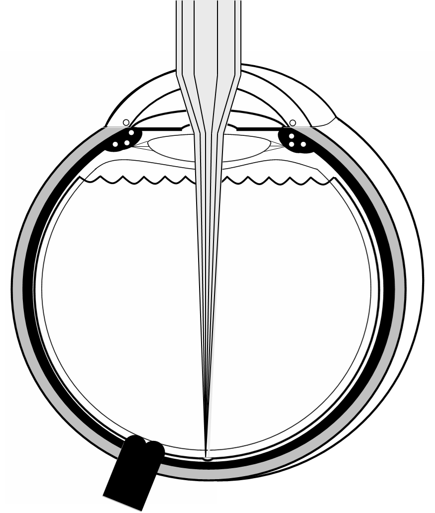 La réfraction de lumière sur la macula à travers la cornée puis le cristallin