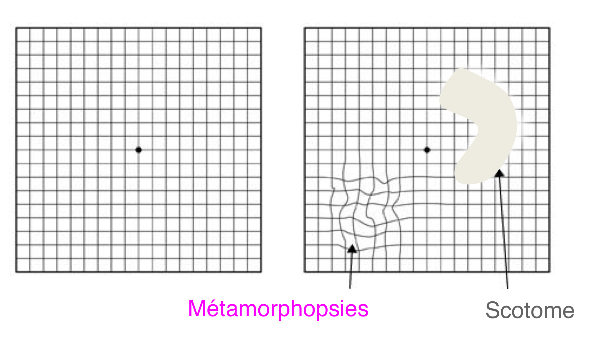 La DMLA peut être à l'origine de déformations ondulantes des lignes droites (métamorphopsies) et/ou de zones de vision centrale floues (scotomes) que le test de la grille d'Amsler peut contribuer à dépister