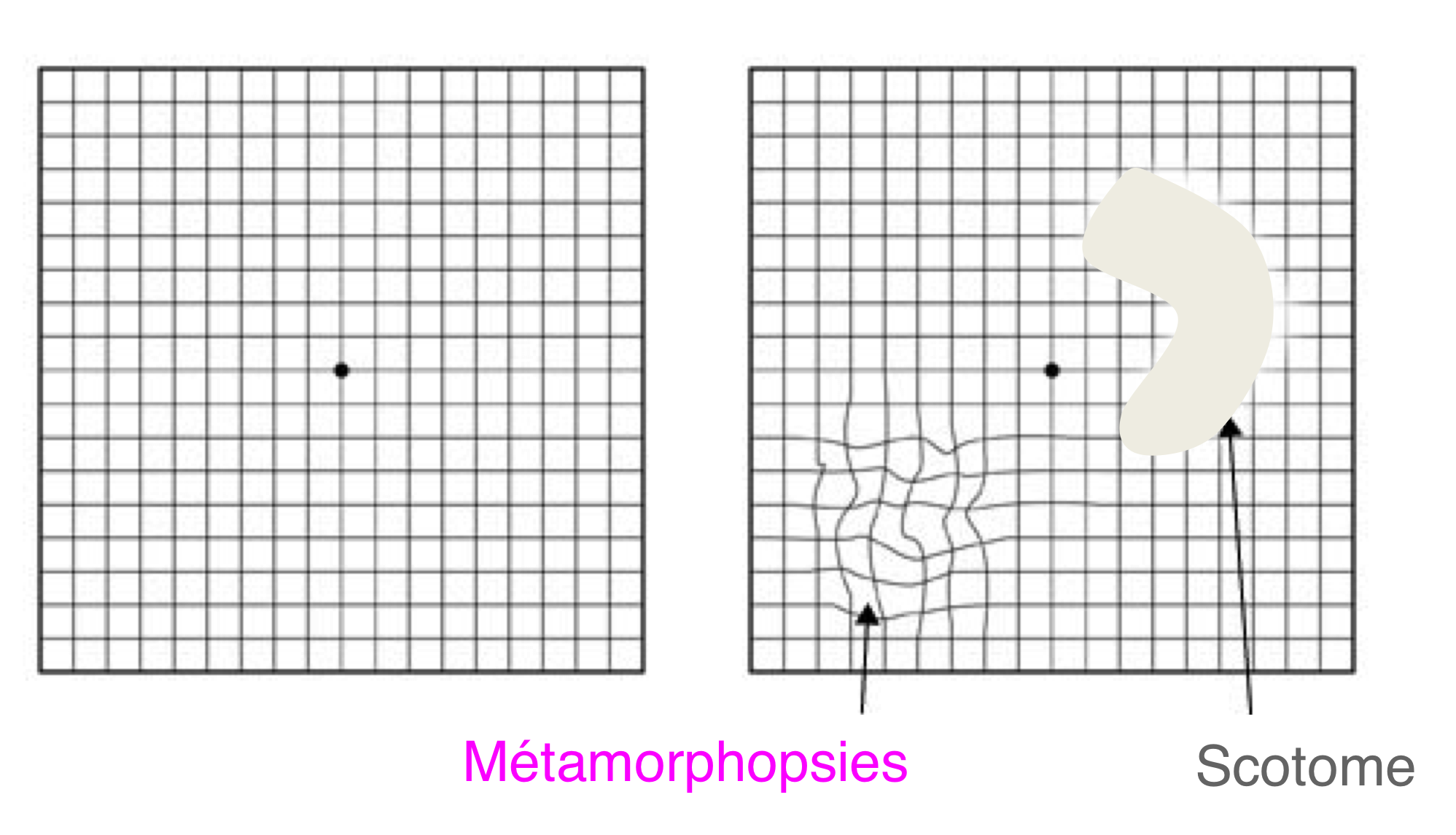 ...(métamorphopsies) et/ou de zones de vision centrale floues (scotomes) qu...