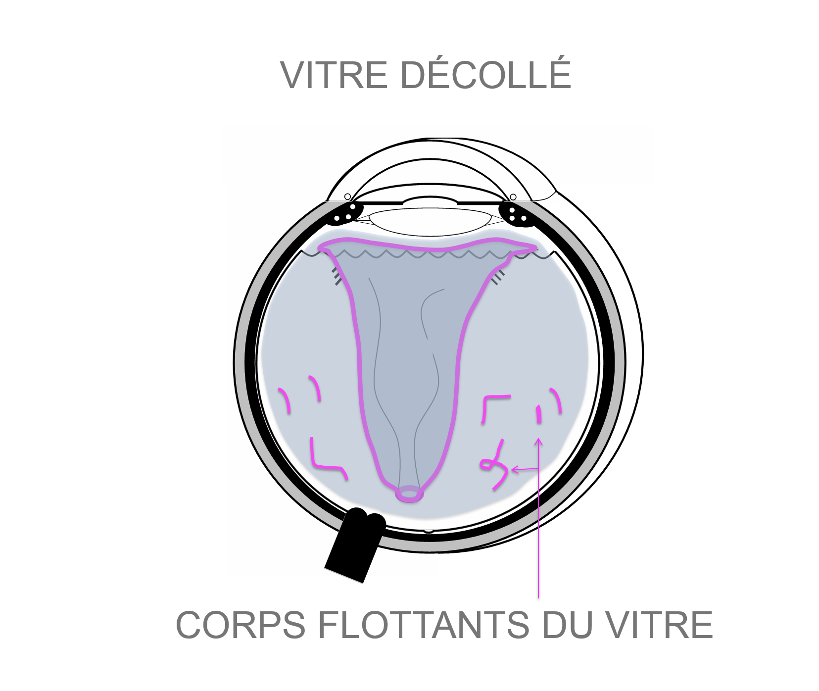 une fois décollée de la rétine l'enveloppe du vitré (la hyaloïde) flotte dans la cavité vitréenne pouvant occasionner la perception de corps flottants