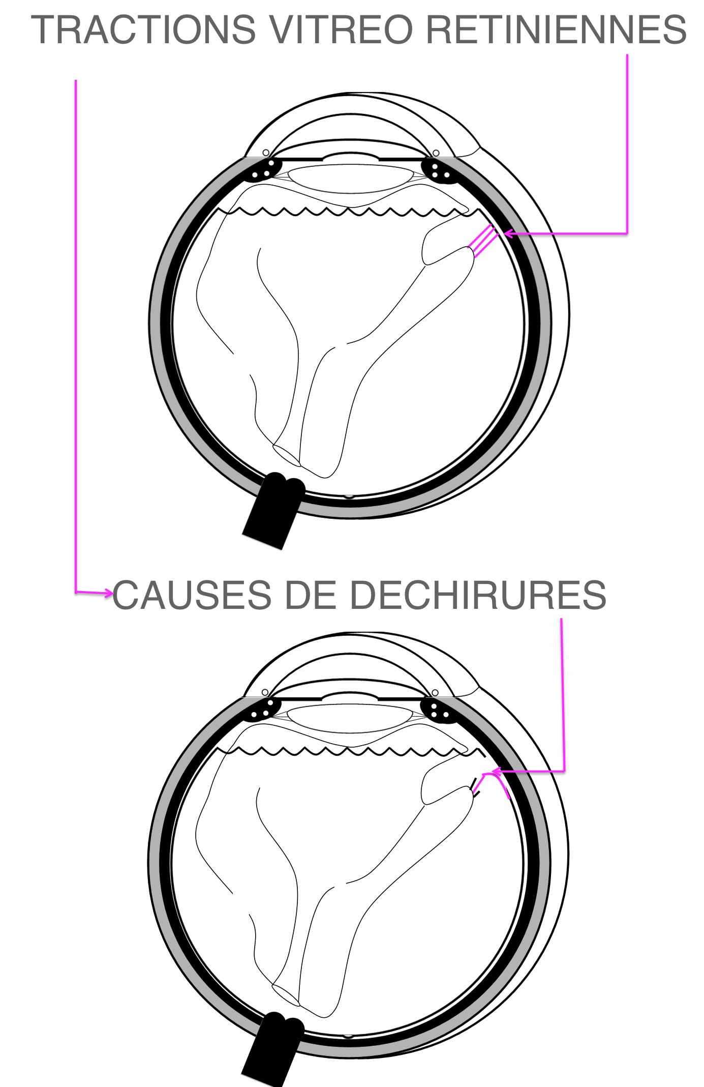 Pathologies oculaires - Les corps flottants et le décollement ...