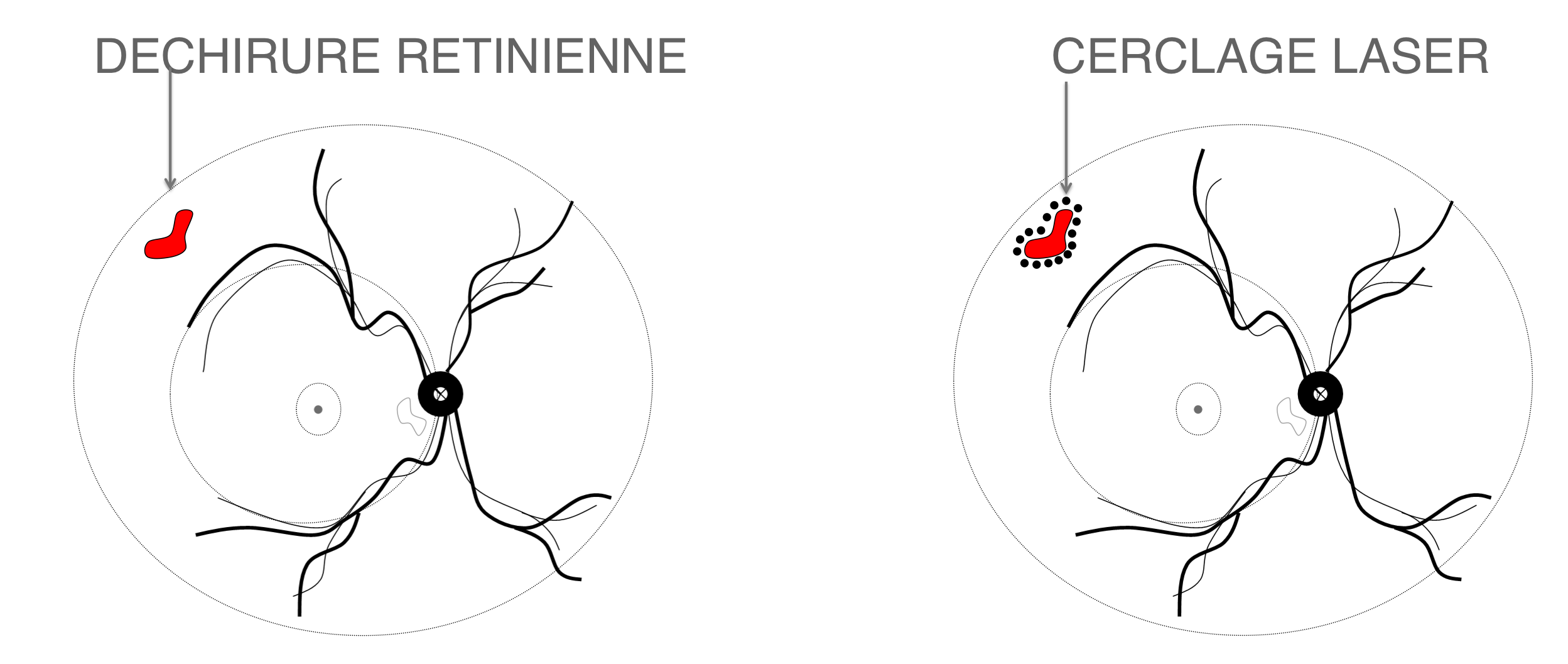 déchirure rétinienne traitée par cerclage laser