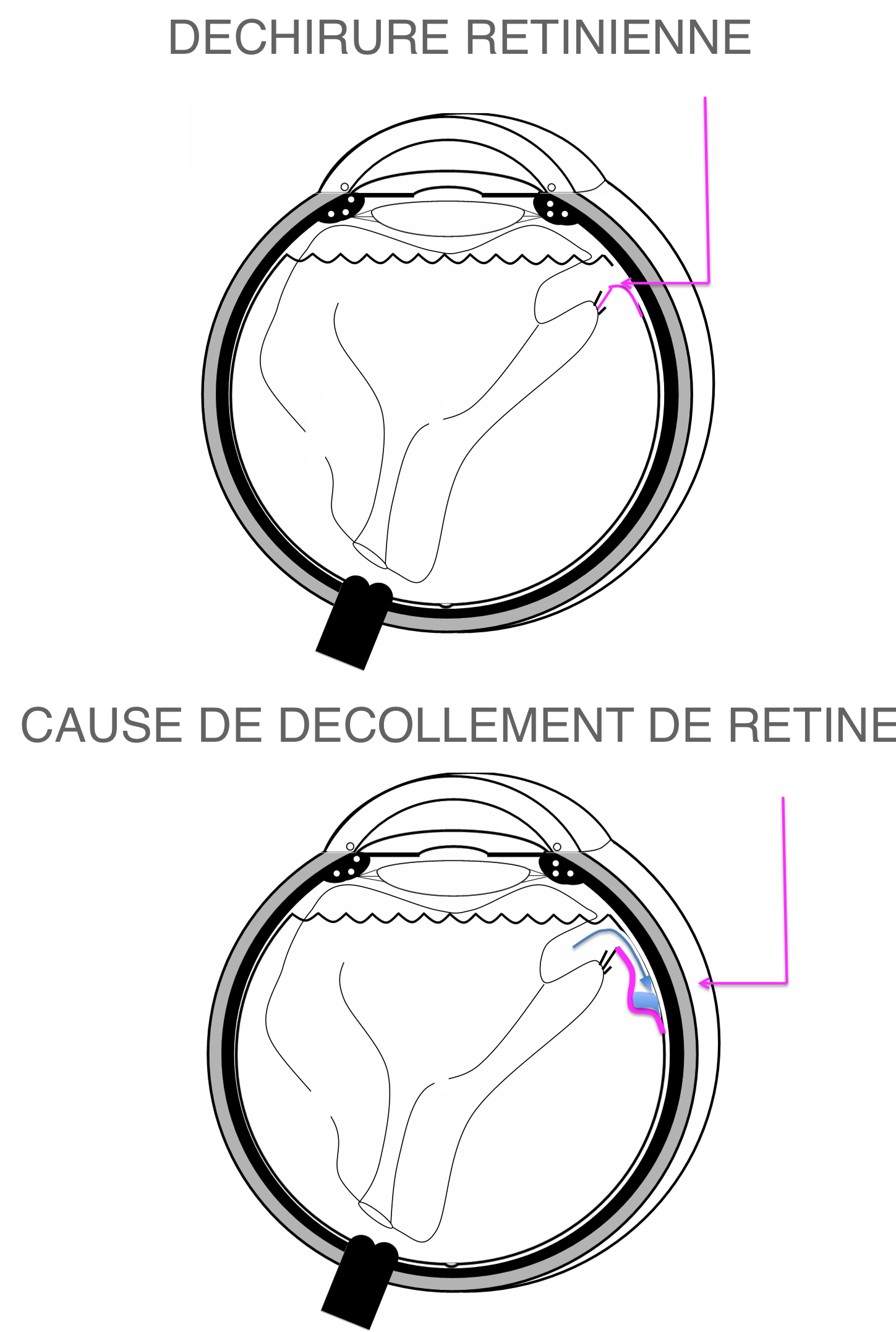 déchirure rétinienne survenue lors du décollement postérieur du vitré compliquée de décollement de rétine débutant