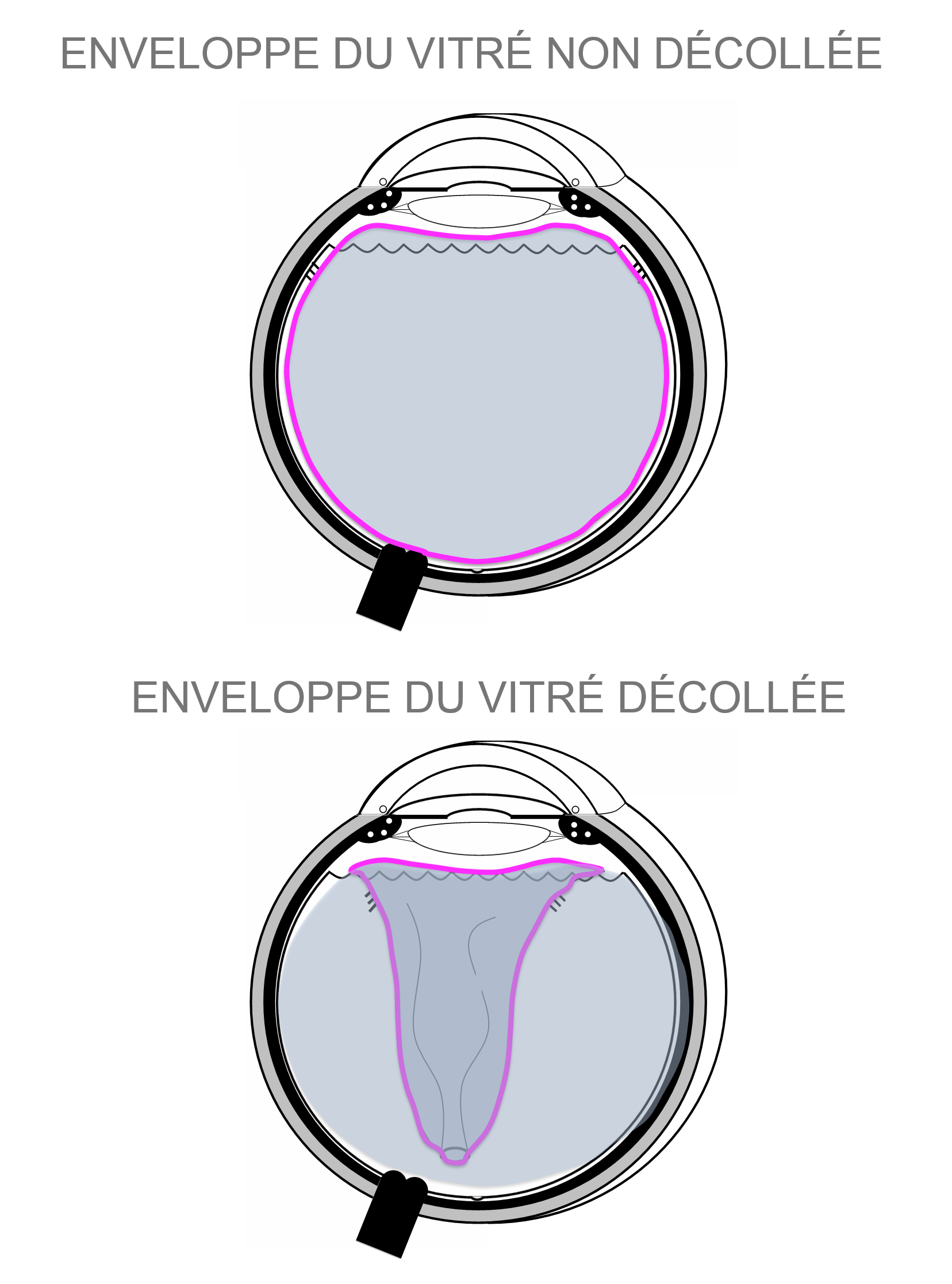 le vitré avant (en haut) et après (en bas) son détachement de la rétine appelé décollement postérieur du vitré