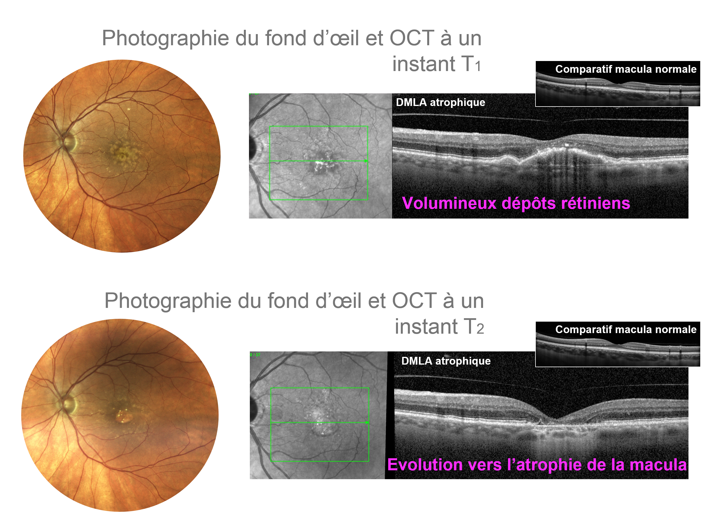 évolution OCT vers la DMLA atrophique