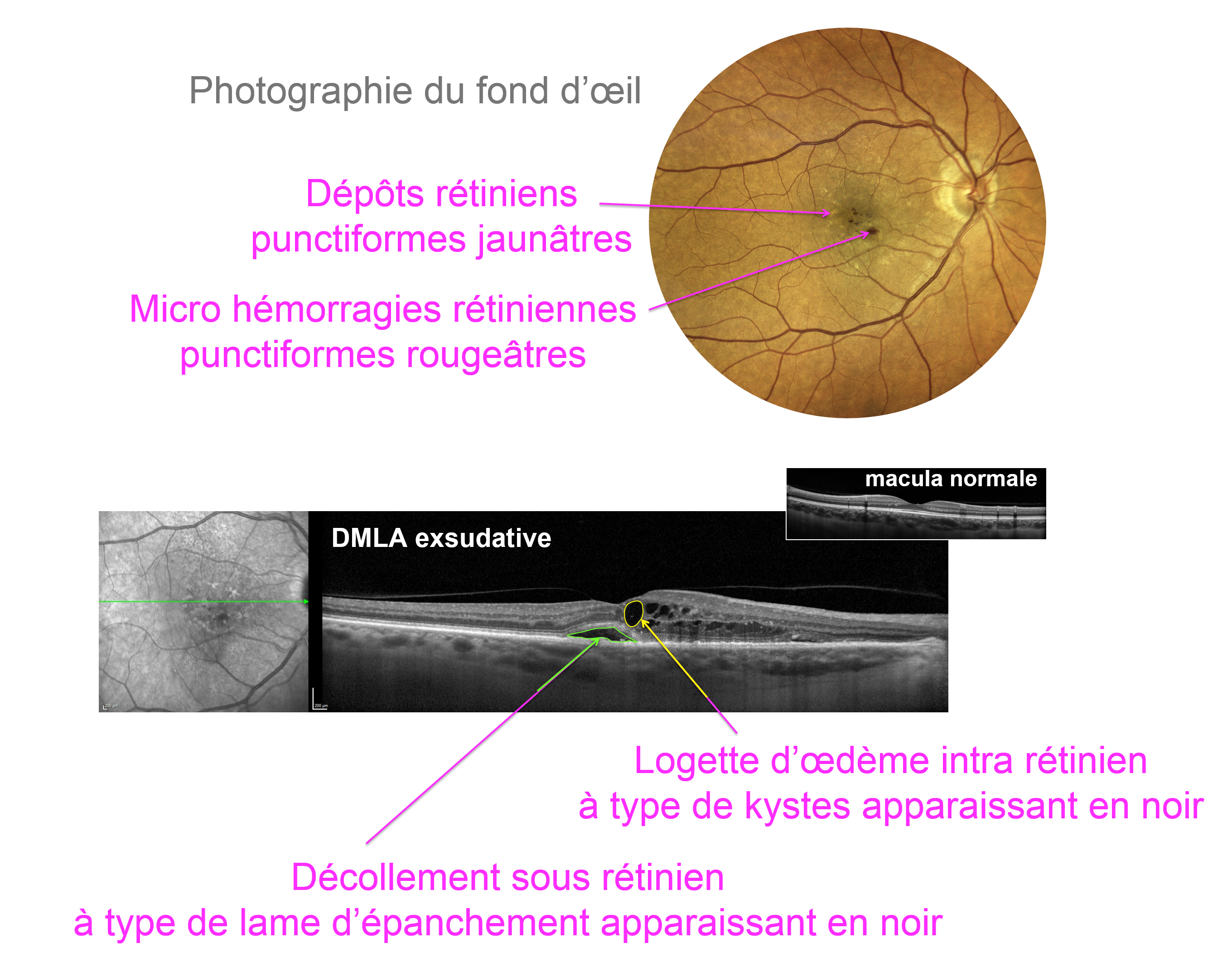 signes OCT de DMLA exsudative