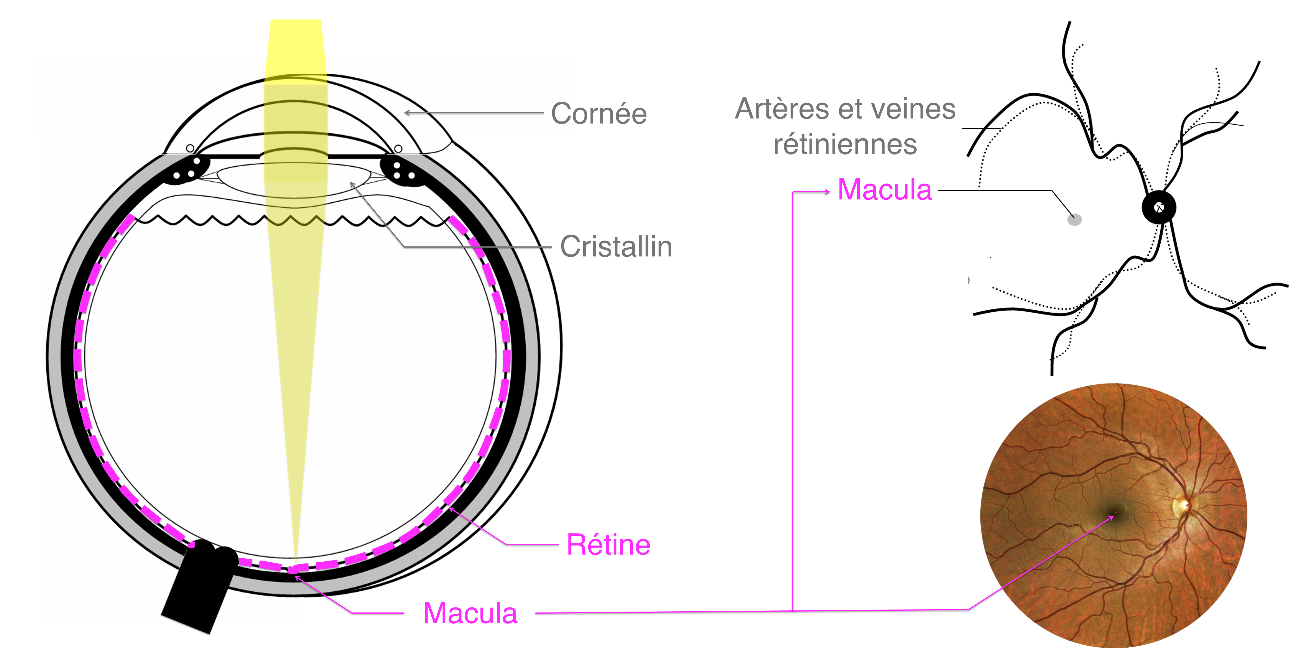 anatomie de la rétine atteinte en cas de complications liées au diabète