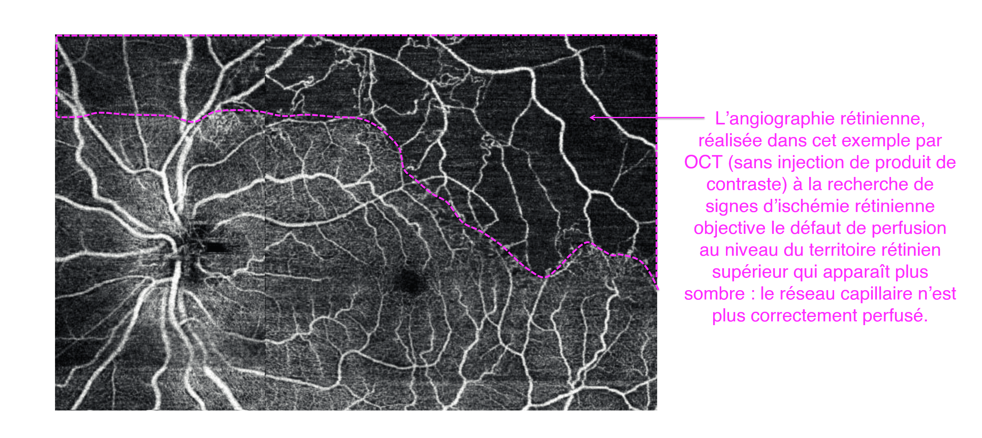 les complications rétiniennes liées au diabète : signes d'ischémie rétinienne visibles sur l'OCT angiographie