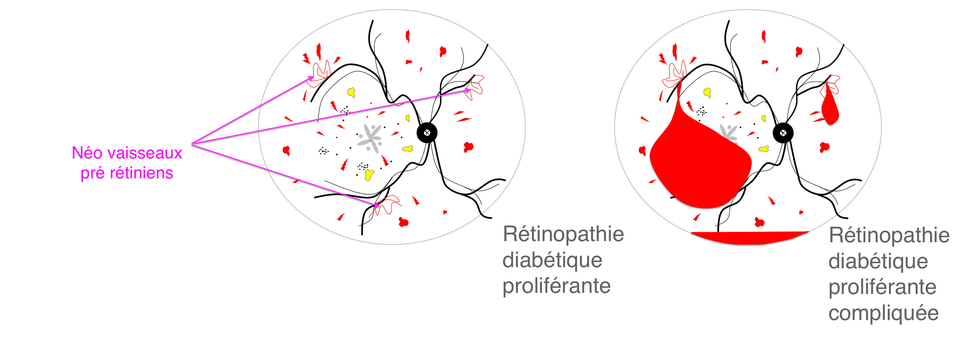 les complications rétiniennes liées au diabète : les signes de rétinopathie proliférante et de maculopathie diabétique