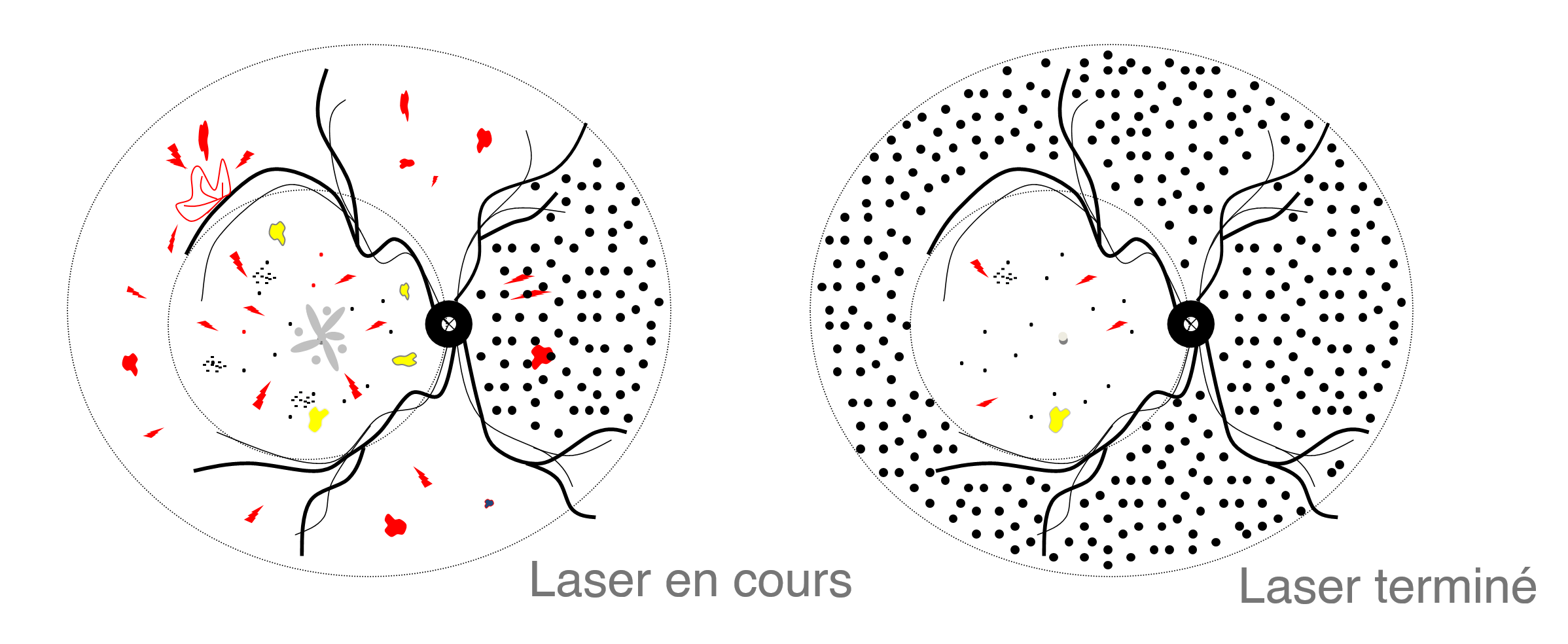 les complications rétiniennes liées au diabète : le traitement de la rétinopathie diabétique par photocoagulation LASER (Photocoagulation Pan Rétinienne ou PPR)