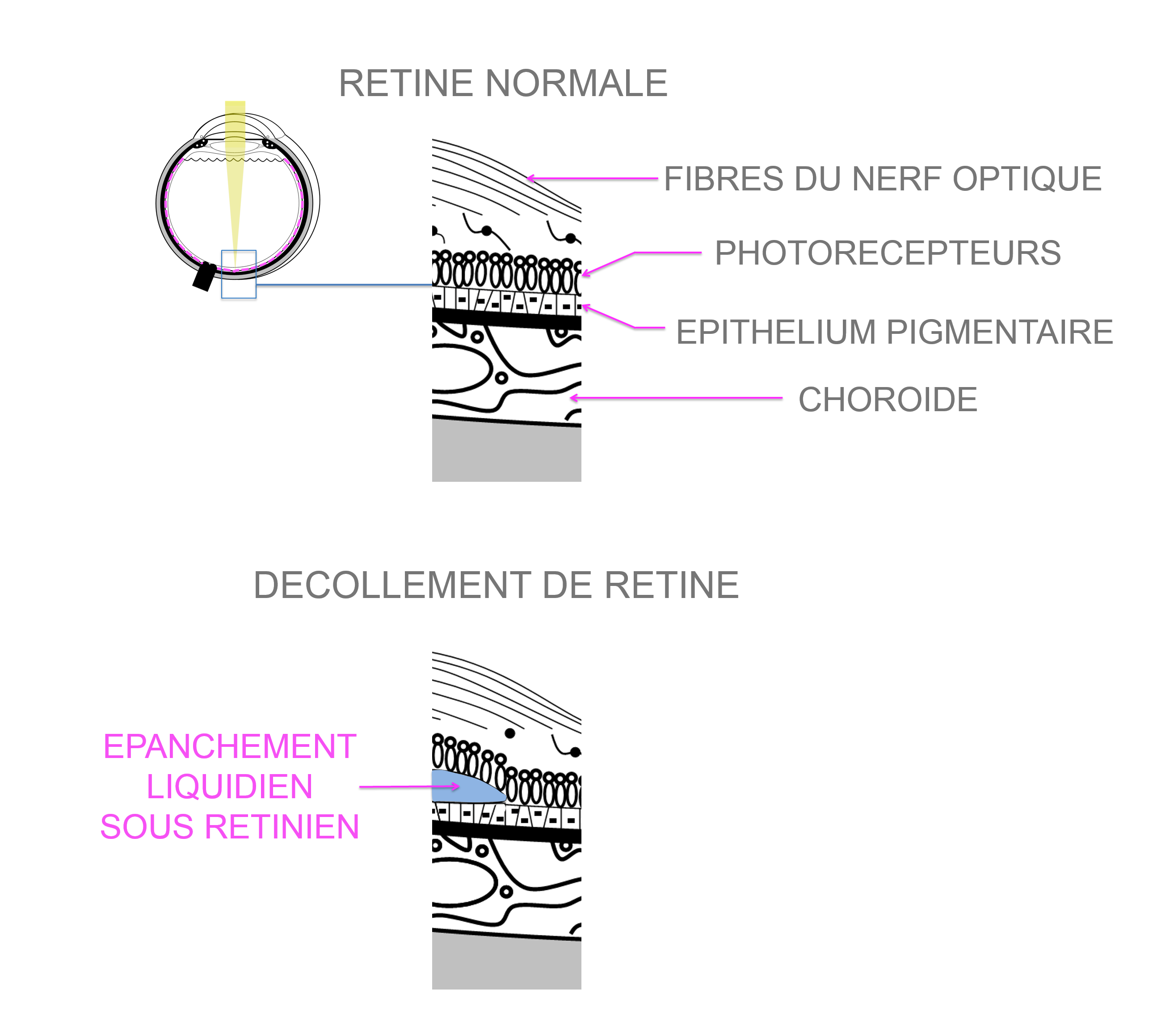 décollement de rétine : localisation de l'épanchement liquidien sous rétinien en cause dans les décollements de rétine