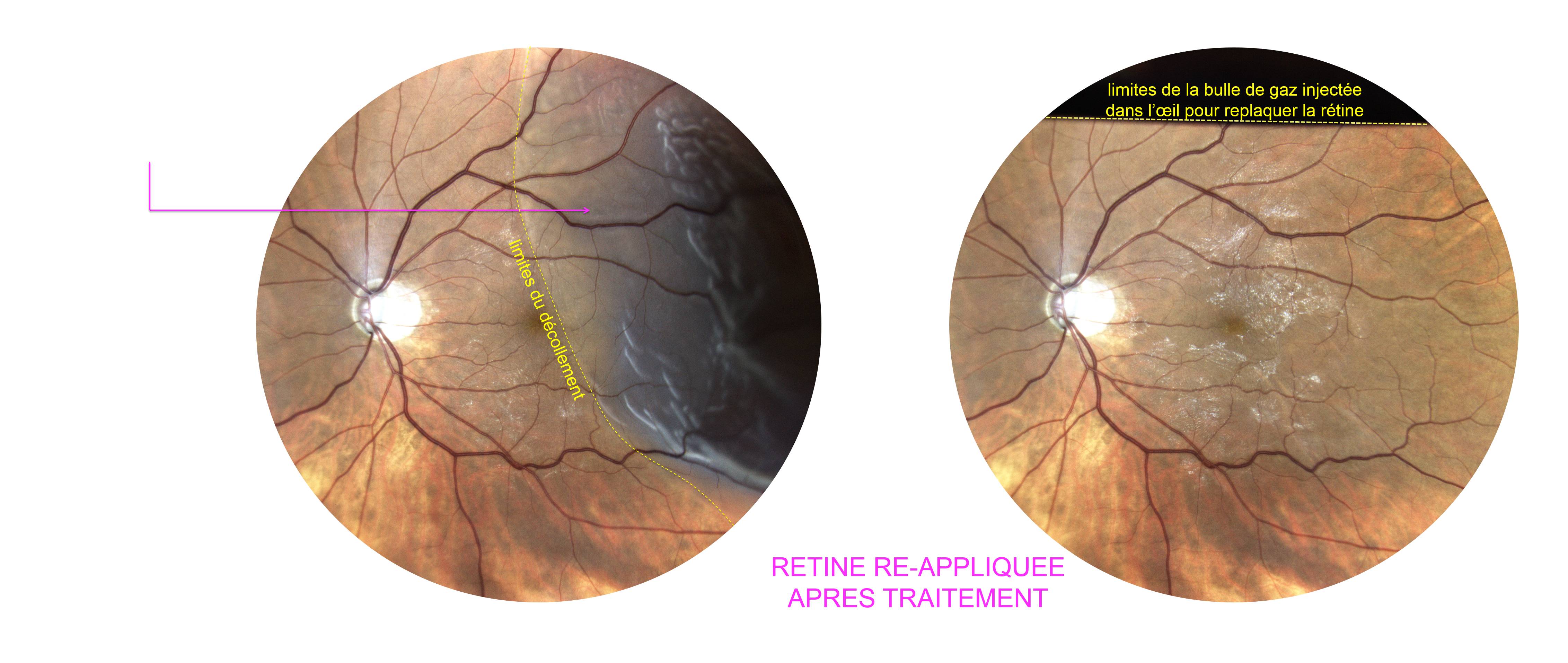 photographie du fond d'oeil réalisées avant et après traitement d'un décollement de la rétine