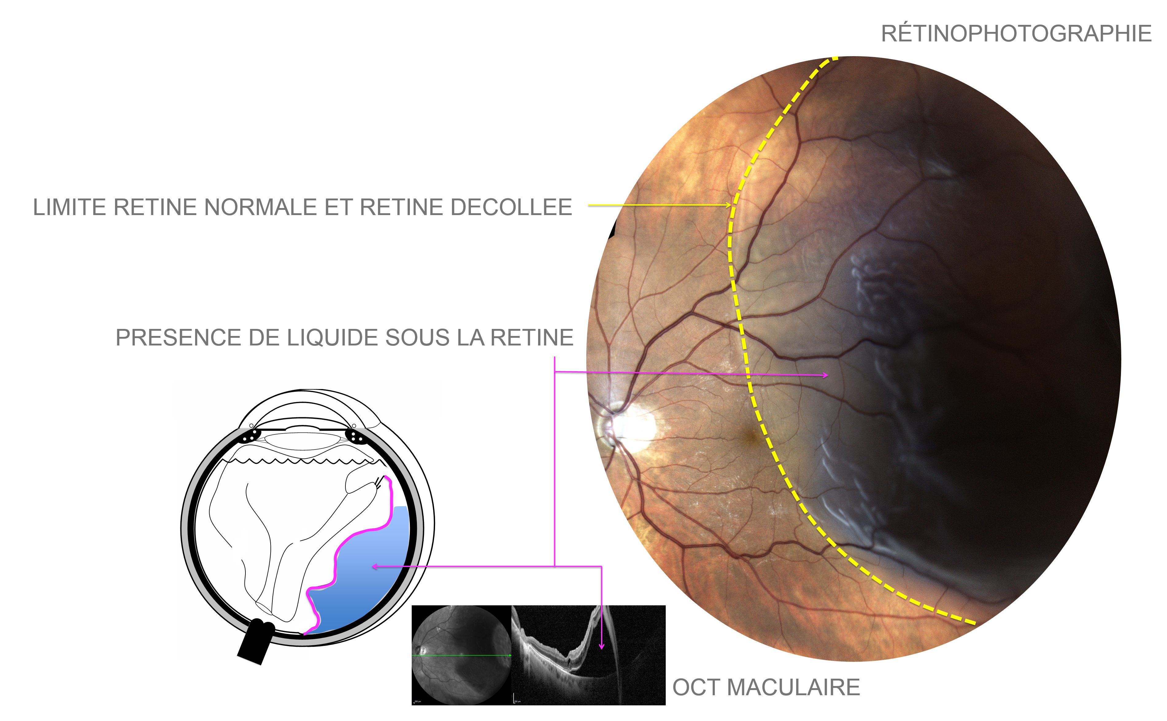 décollement de rétine : la rétine décollée apparait soulevée avec un aspect grisâtre de papier calque froissé sur la photographie du fond d'oeil