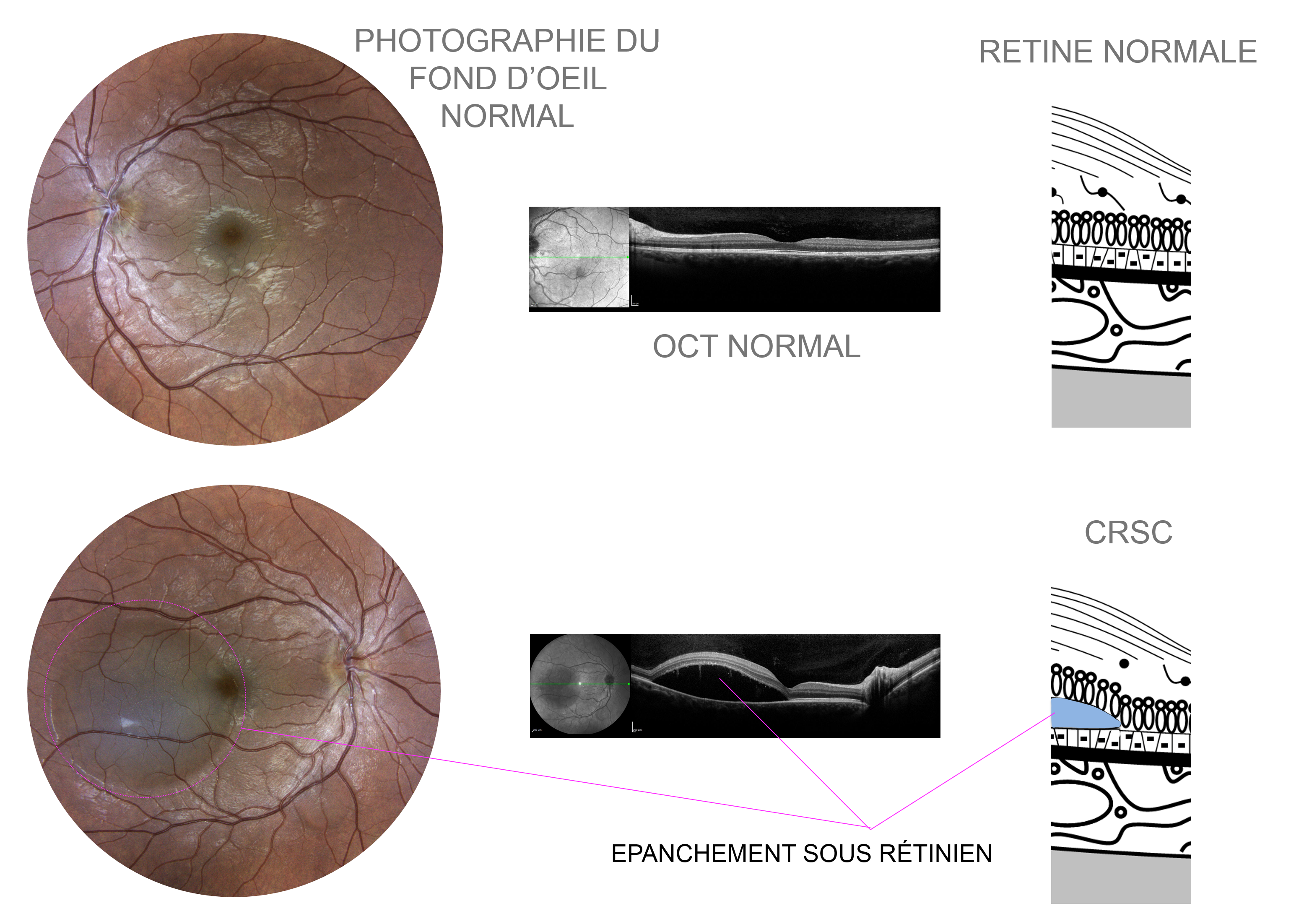 présence d'un décollement séreux sous rétinien sur les photographies du fond d'oeil et l'OCT en lien avec une CRSC