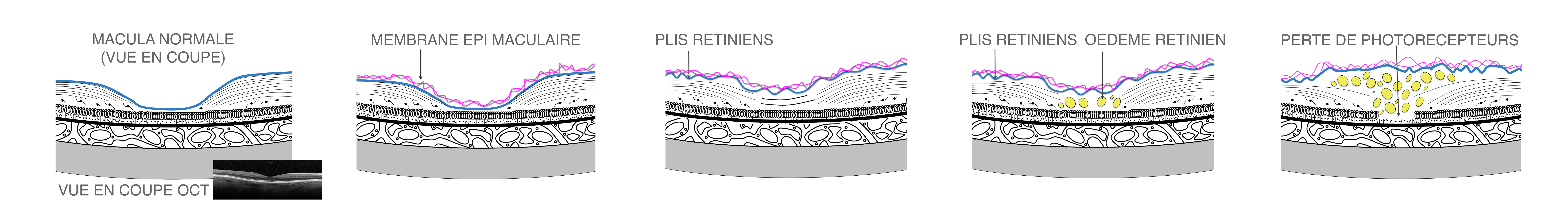 membrane épirétinienne : apparition et évolution