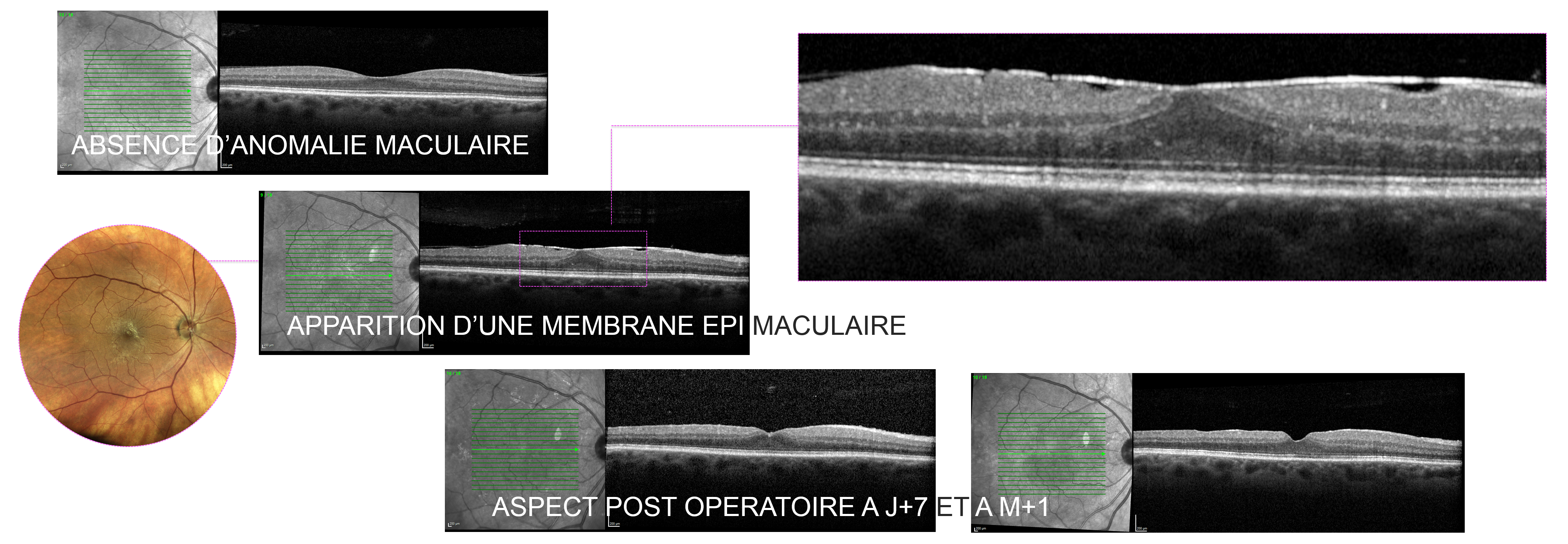 membrane épi-rétinienne : évolution avant et après traitement chirurgical par vitrectomie pelage