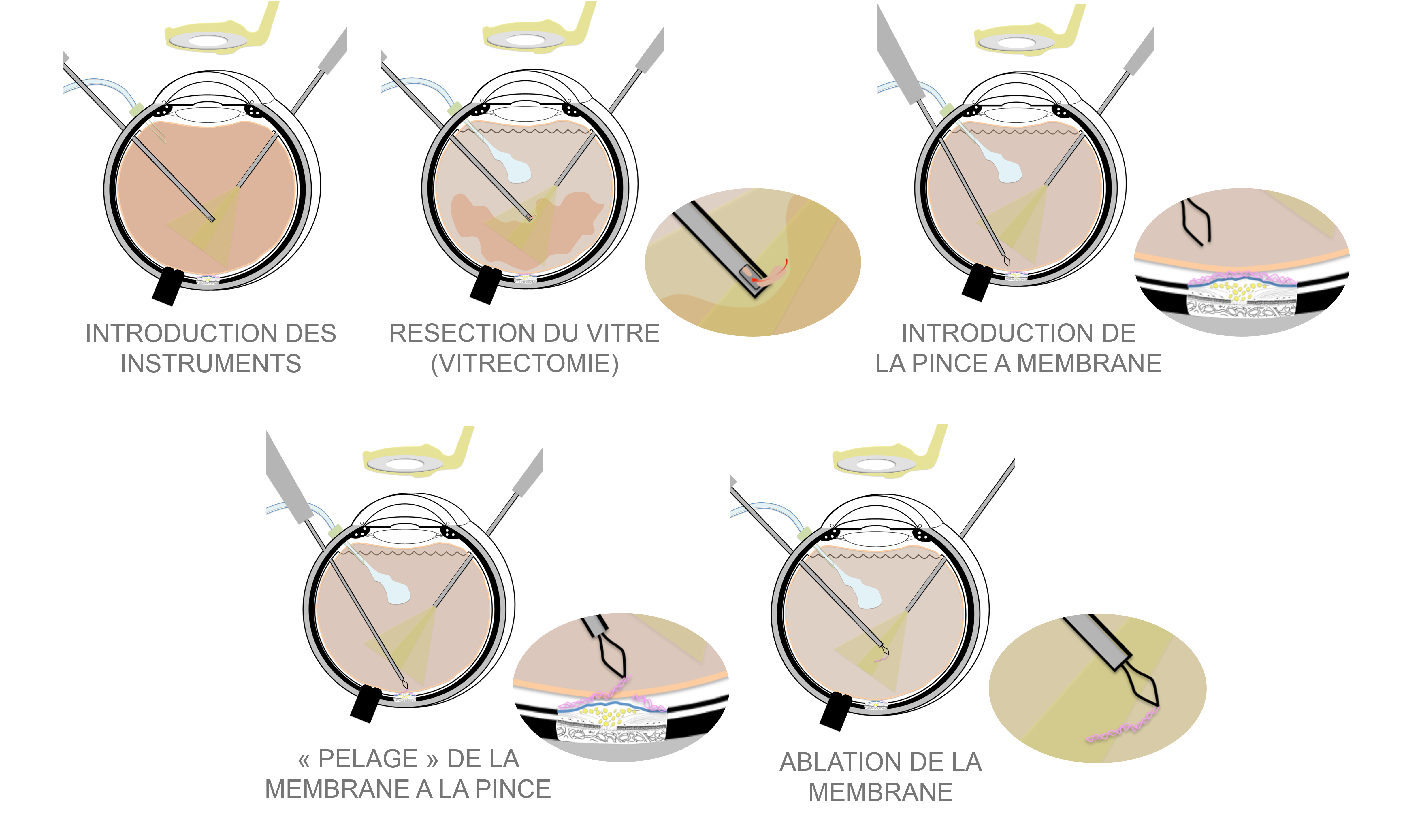 membrane épi-rétinienne : traitement chirurgical par vitrectomie pelage