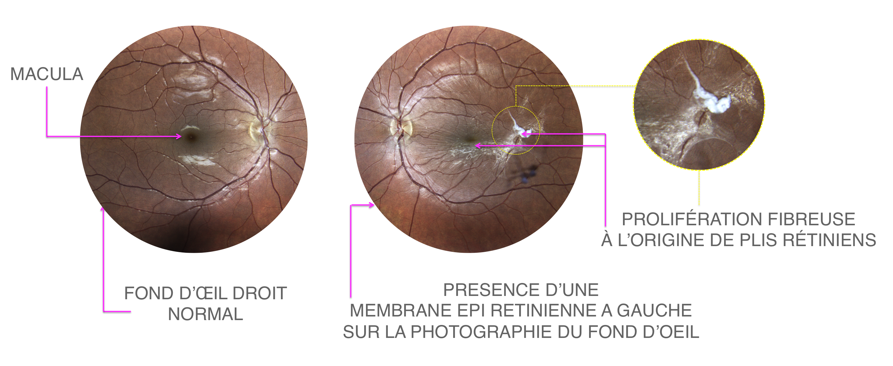 membrane épirétinienne : rétraction fibreuse visible au centre de la photographie du fond d'oeil