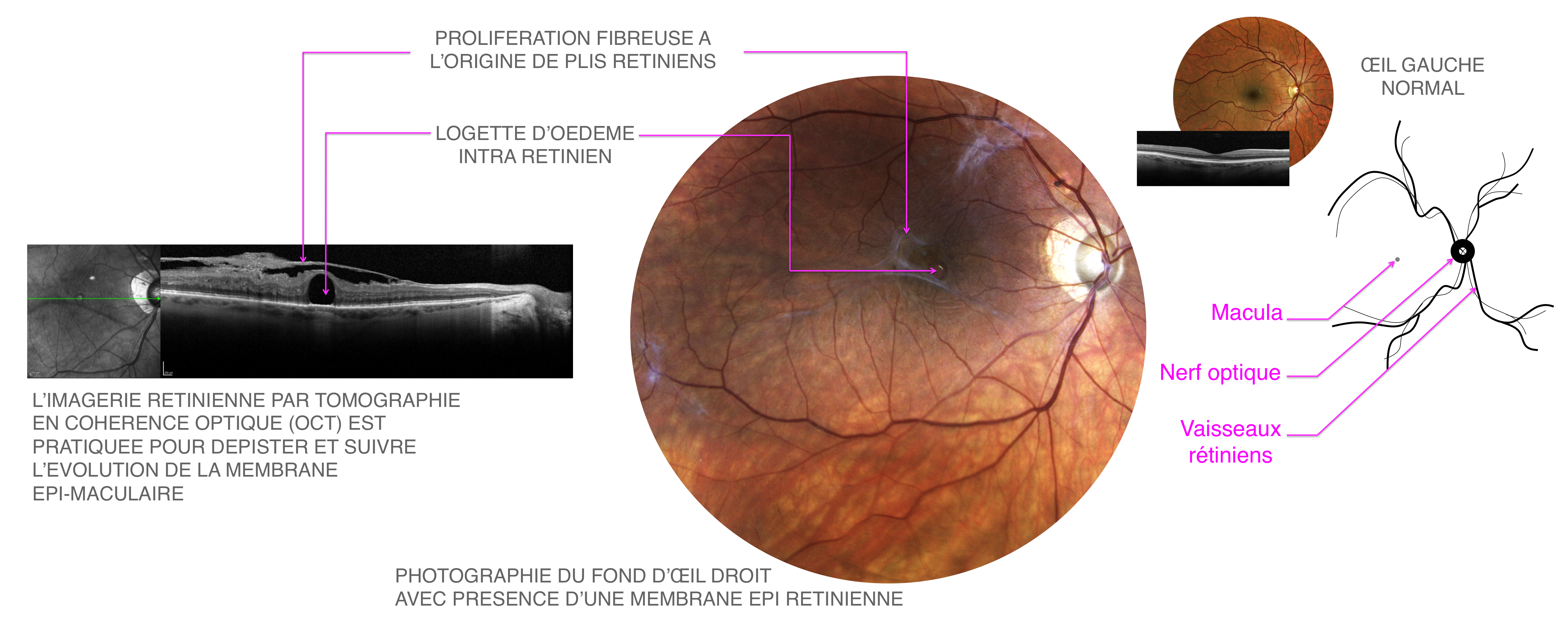 membrane épi-rétinienne : imagerie en rétinophographie et en OCT