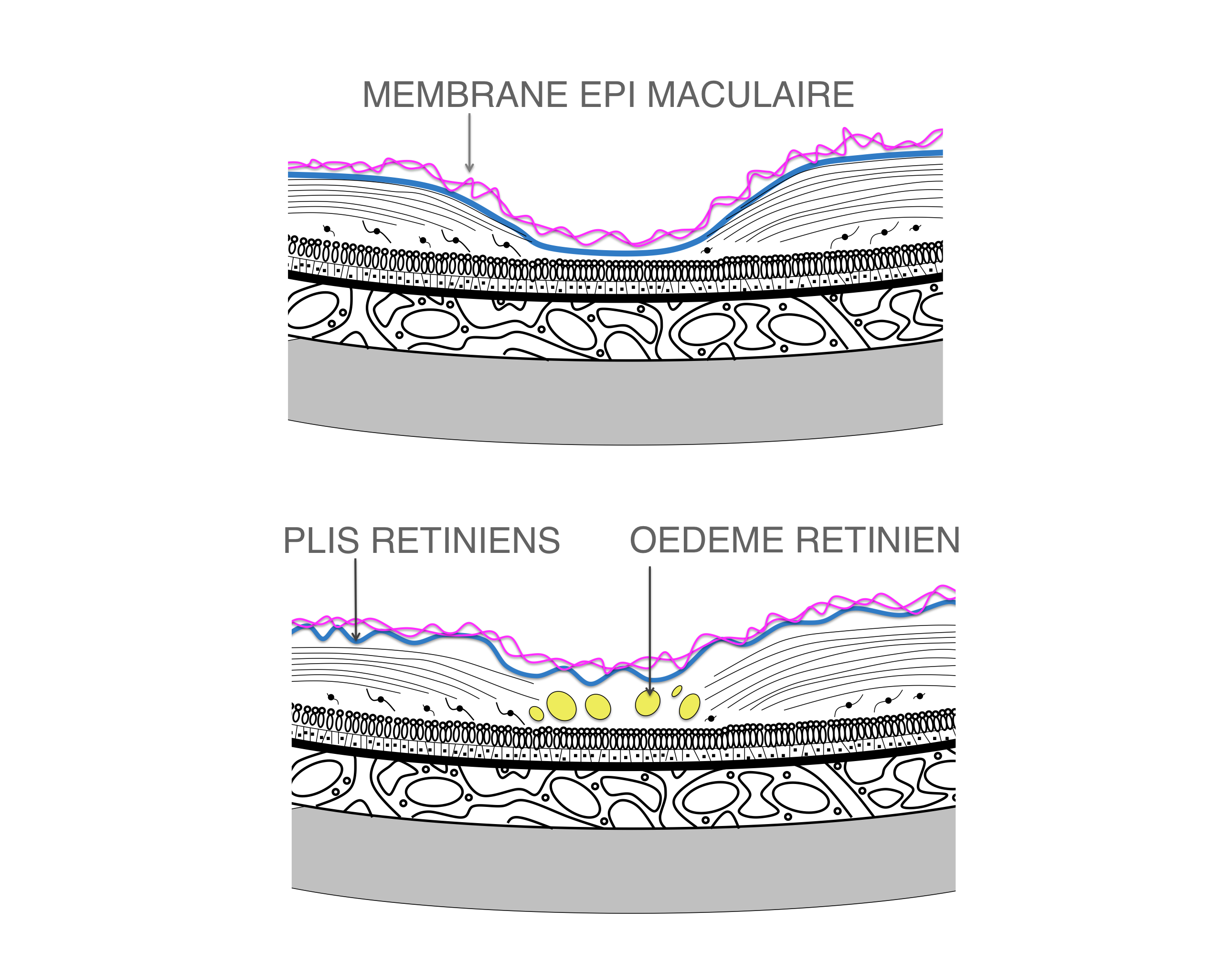 membrane épirétinienne compliquée de plis et d'oedème intra rétinien